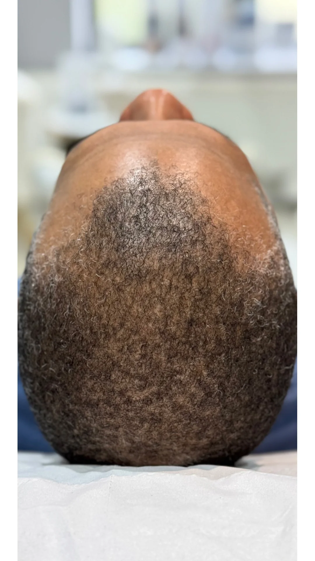 PRP Hair Loss before — Rejuvena Clinic Bedford