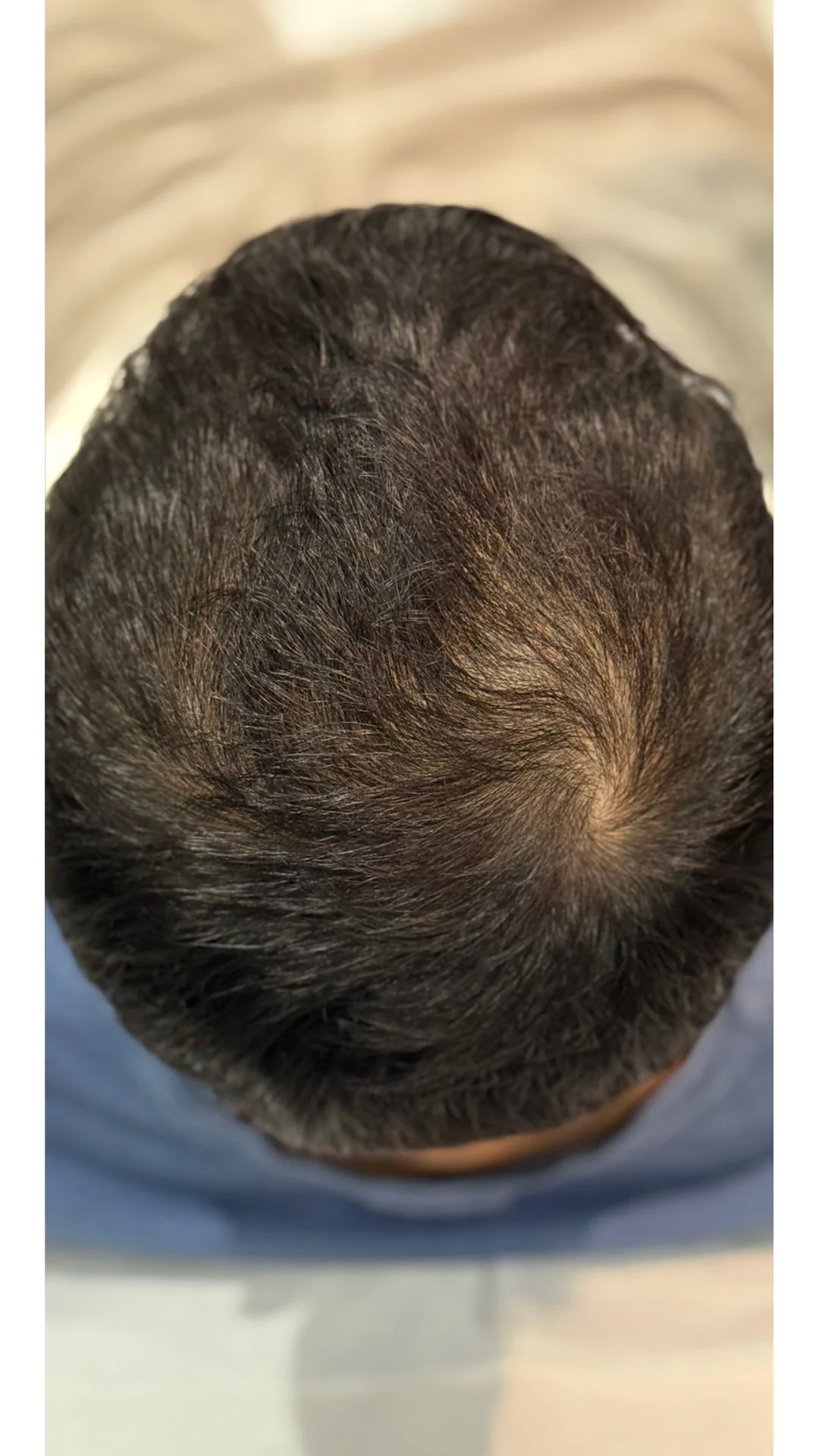 PRP Hair Loss after — Rejuvena Clinic Bedford