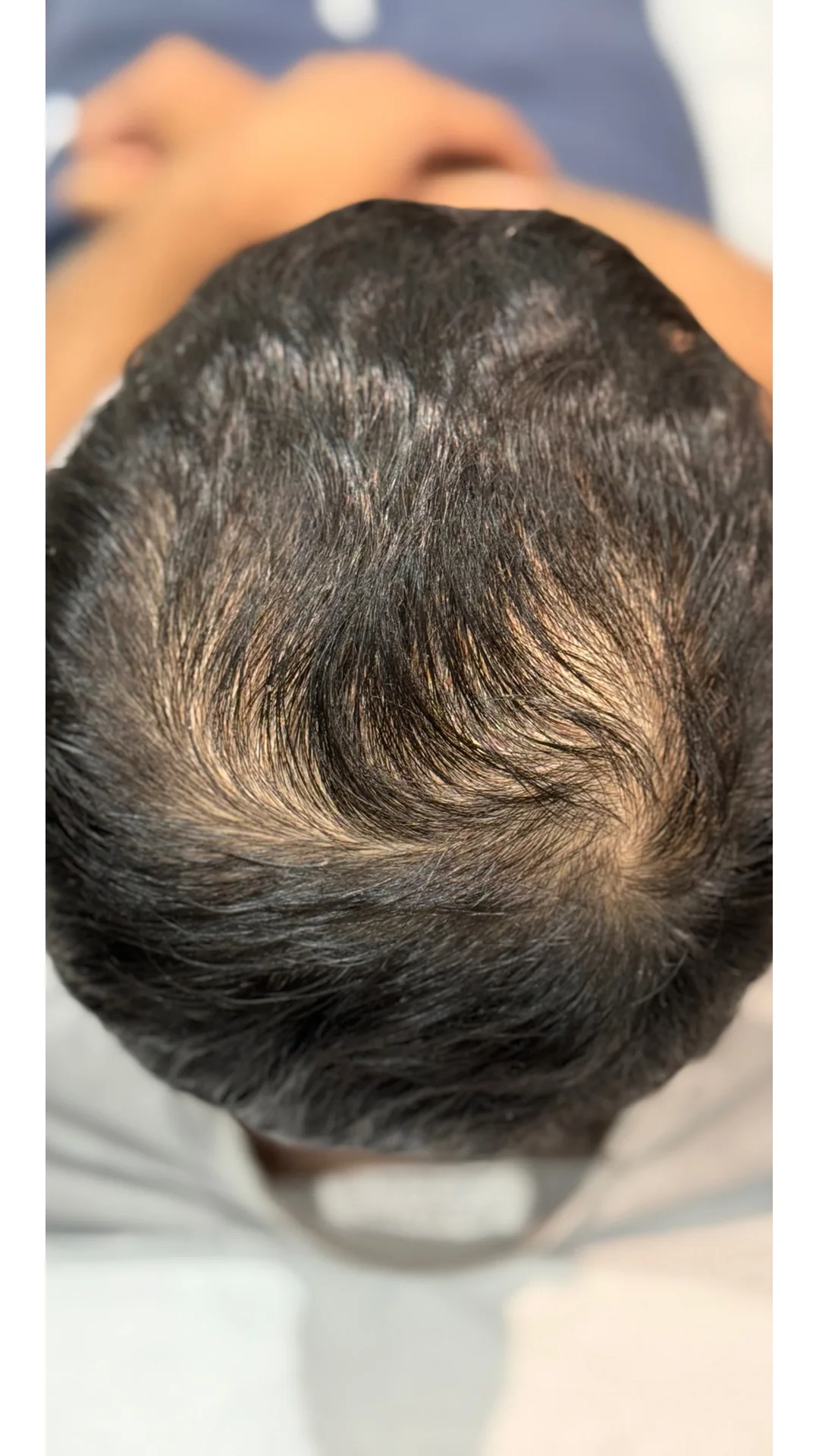 PRP Hair Loss before — Rejuvena Clinic Bedford