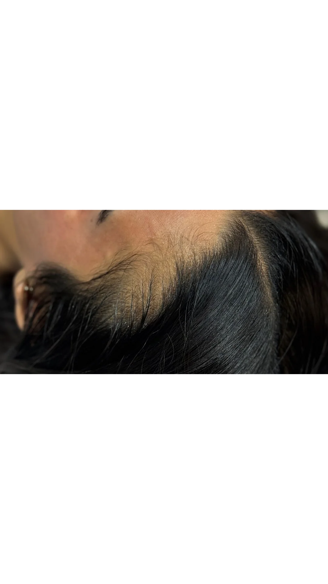 PRP Hair Loss before — Rejuvena Clinic Bedford