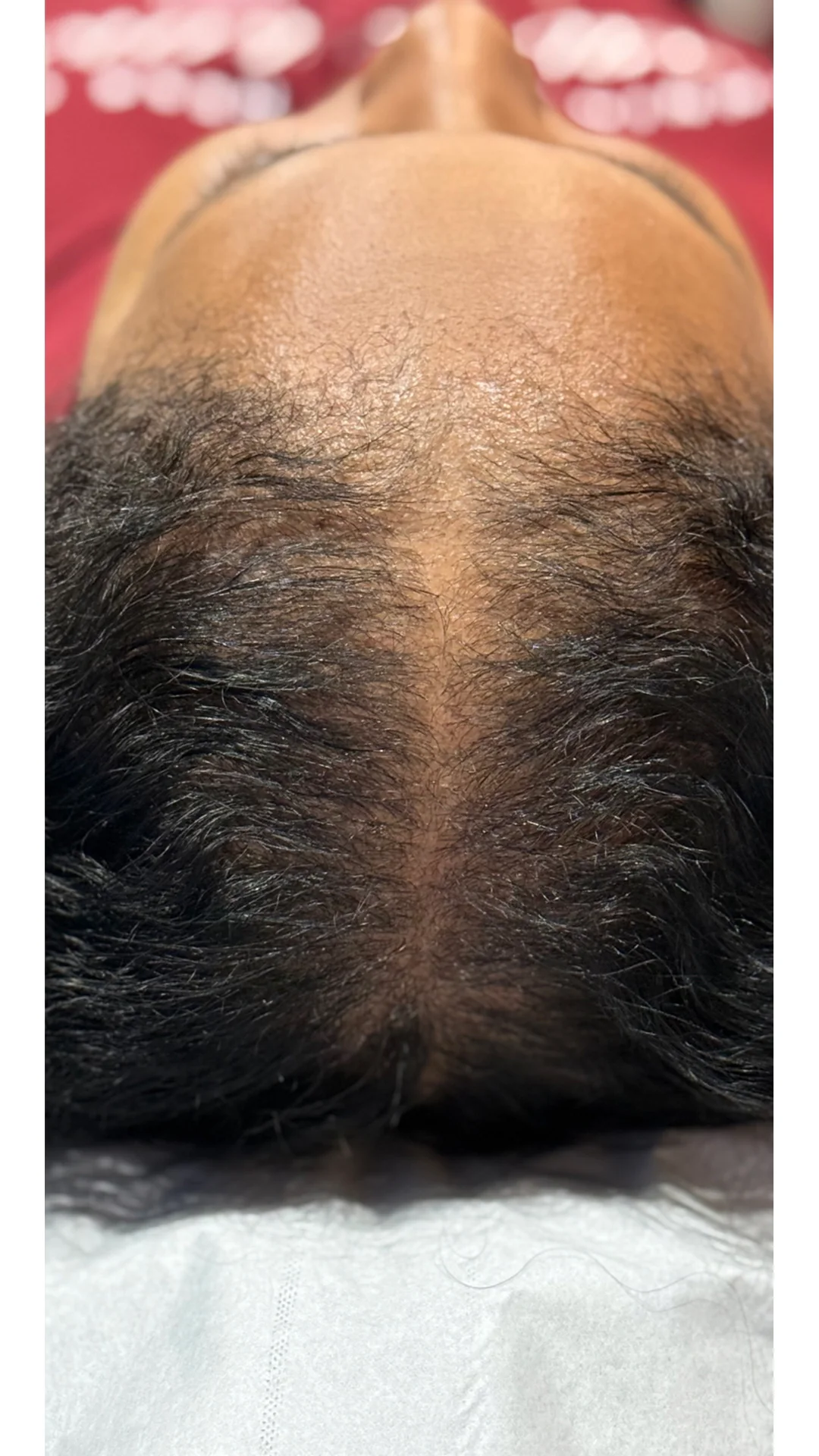 PRP Hair Loss after — Rejuvena Clinic Bedford