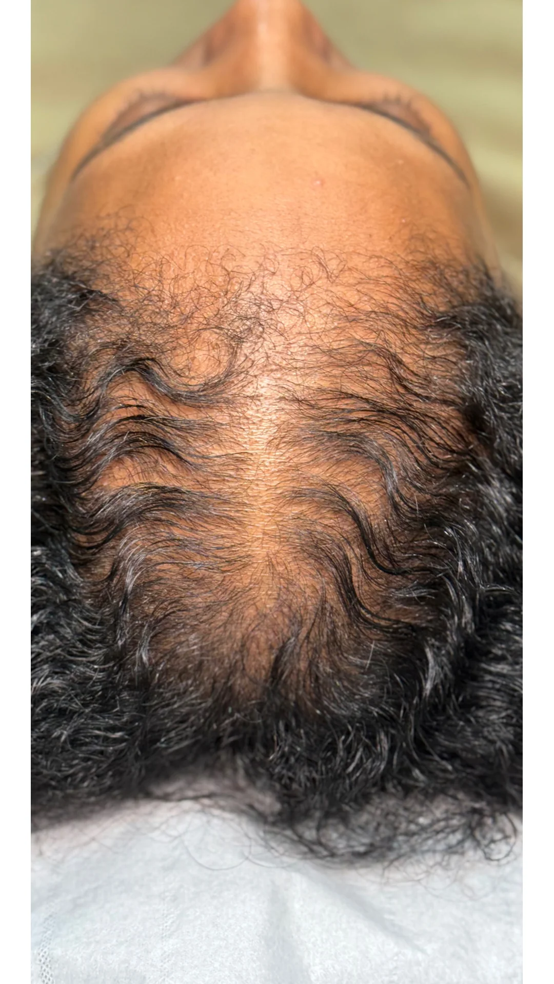 PRP Hair Loss before — Rejuvena Clinic Bedford
