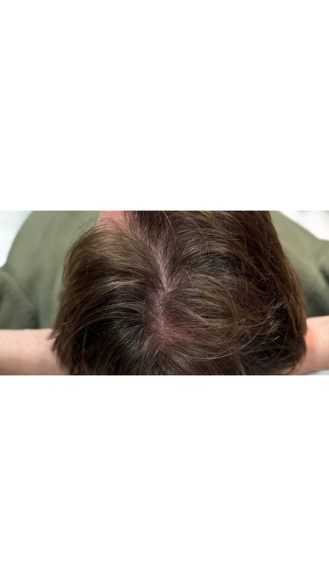 PRP Hair Loss after — Rejuvena Clinic Bedford