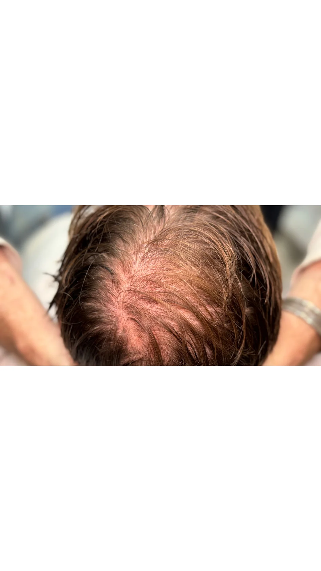 PRP Hair Loss before — Rejuvena Clinic Bedford