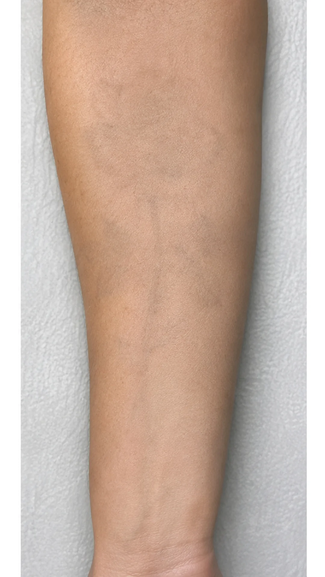 Tattoo Removal after — Rejuvena Clinic Bedford