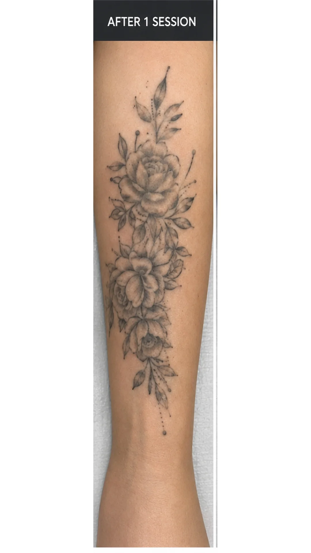 Tattoo Removal (1 session) after — Rejuvena Clinic Bedford
