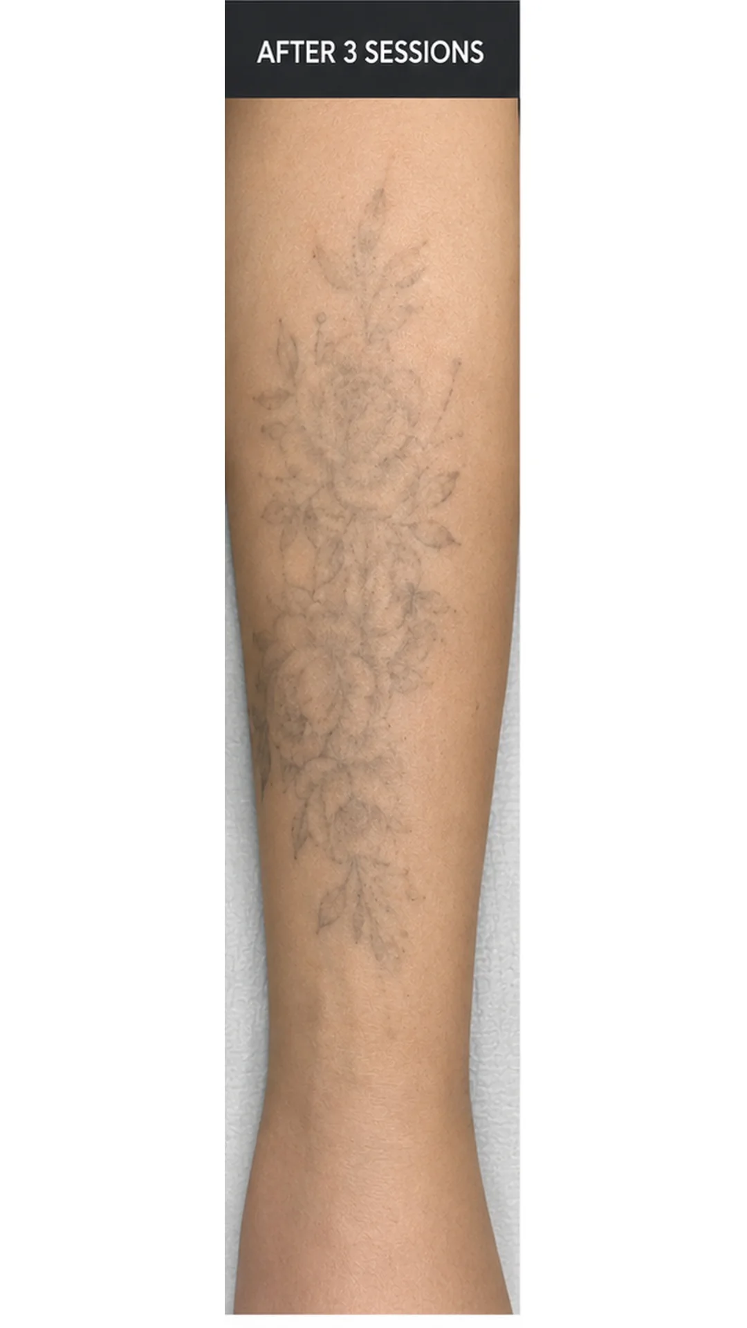 Tattoo Removal (3 sessions) after — Rejuvena Clinic Bedford