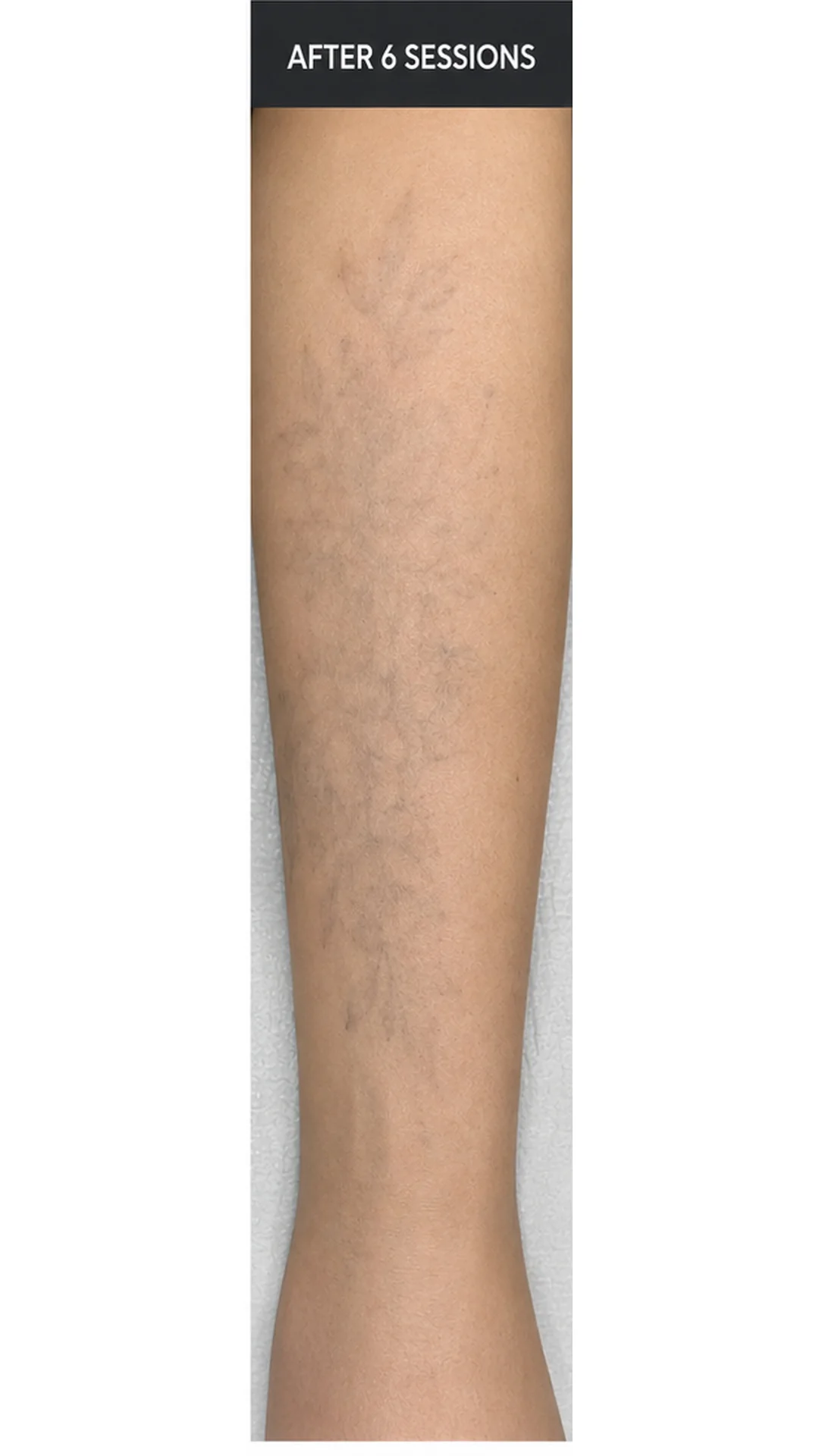 Tattoo Removal (6 sessions) after — Rejuvena Clinic Bedford