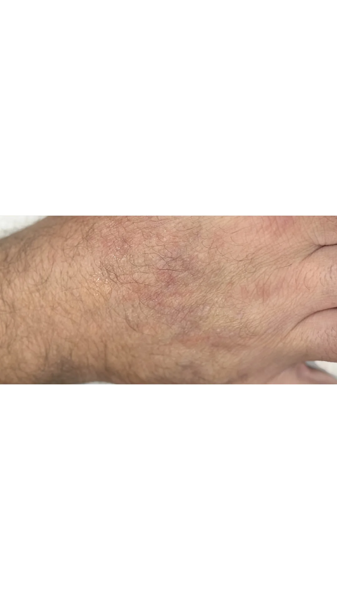 Wart Removal after — Rejuvena Clinic Bedford