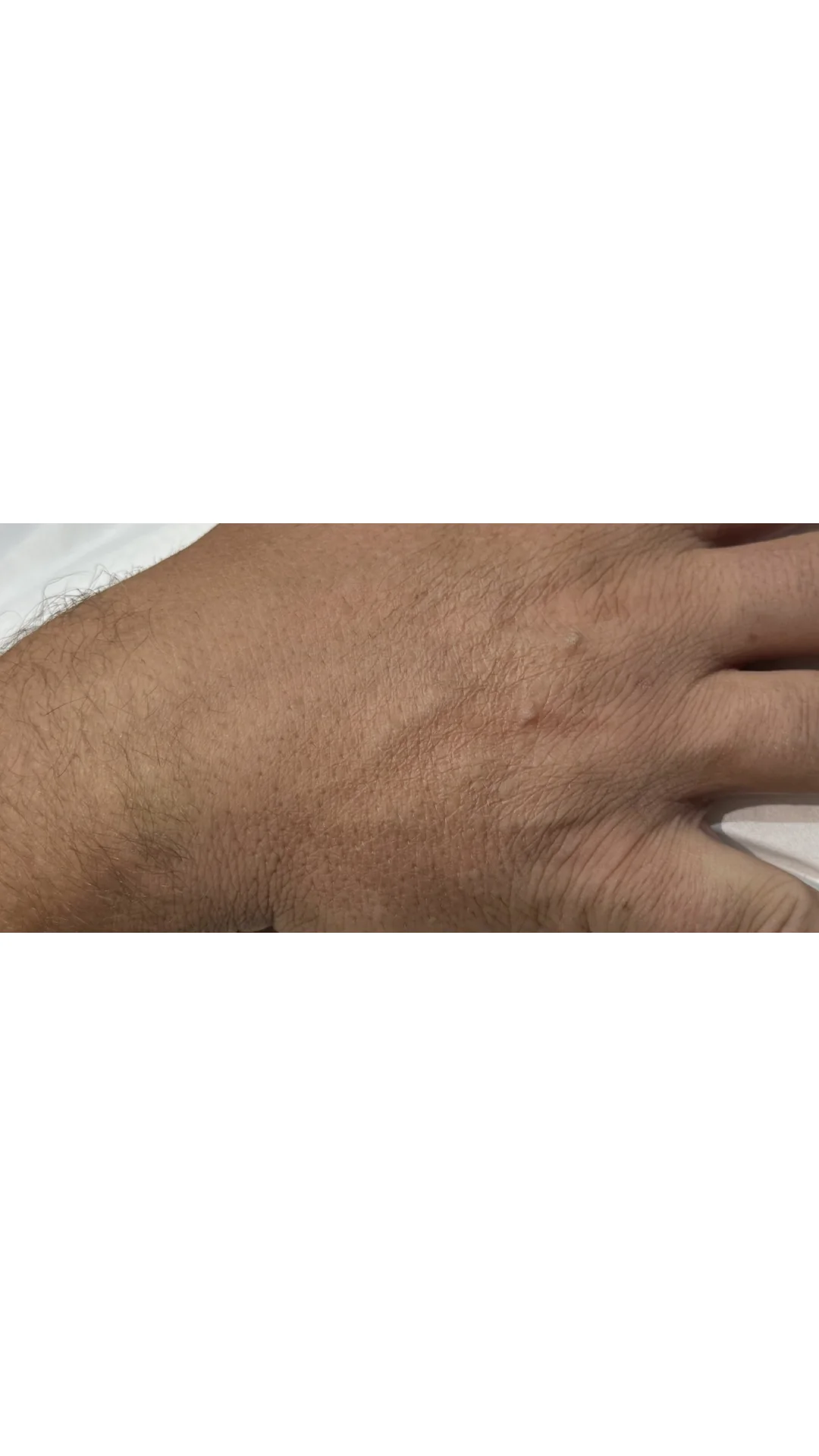 Wart Removal before — Rejuvena Clinic Bedford
