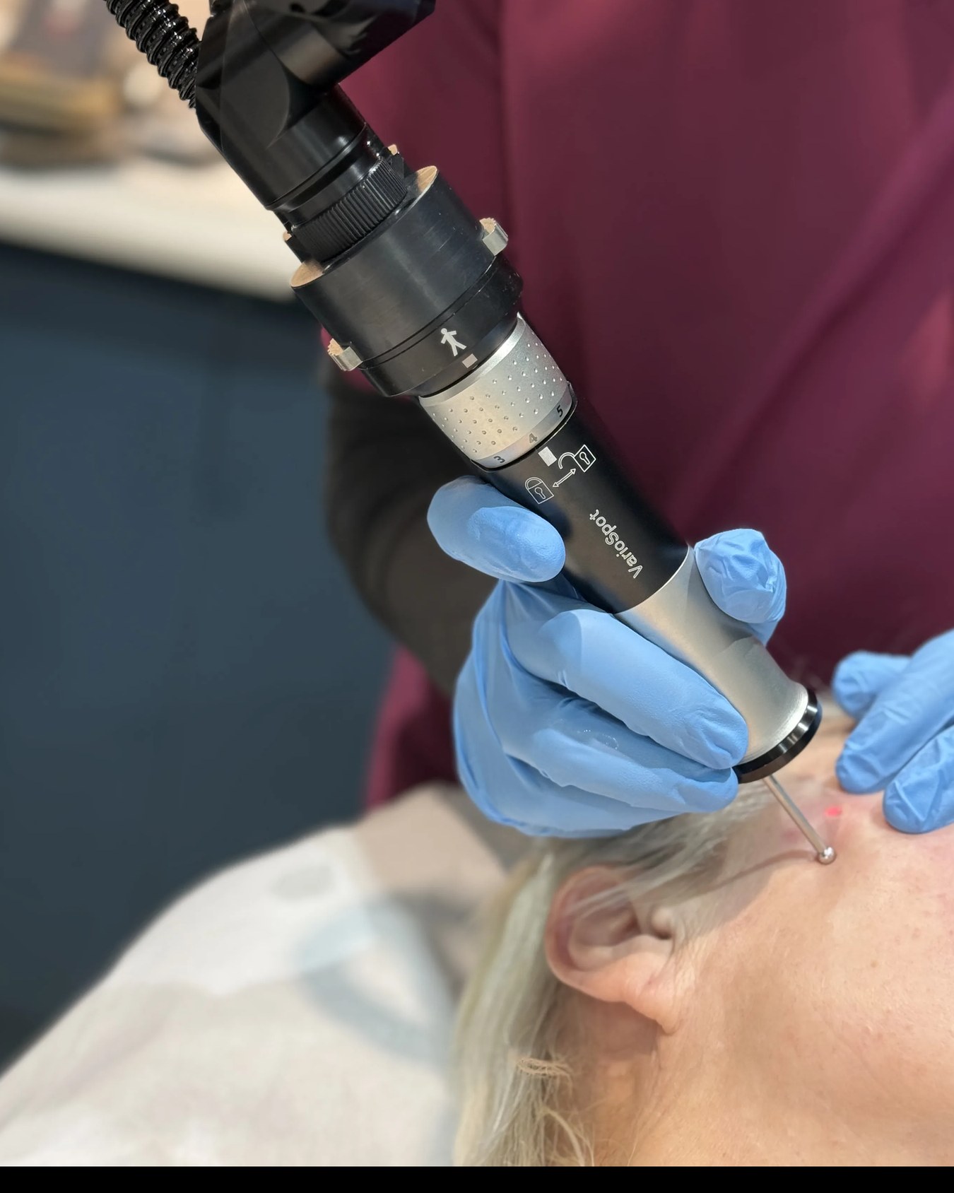 Doctor-led laser lesion treatment near the temple and eye area at Rejuvena Clinic, Bedford — the same gentle, precise technique used for milia removal