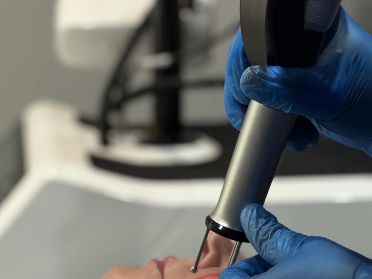 Cool Laser Er:YAG handpiece treating a facial lesion in clinic at Rejuvena, Bedford