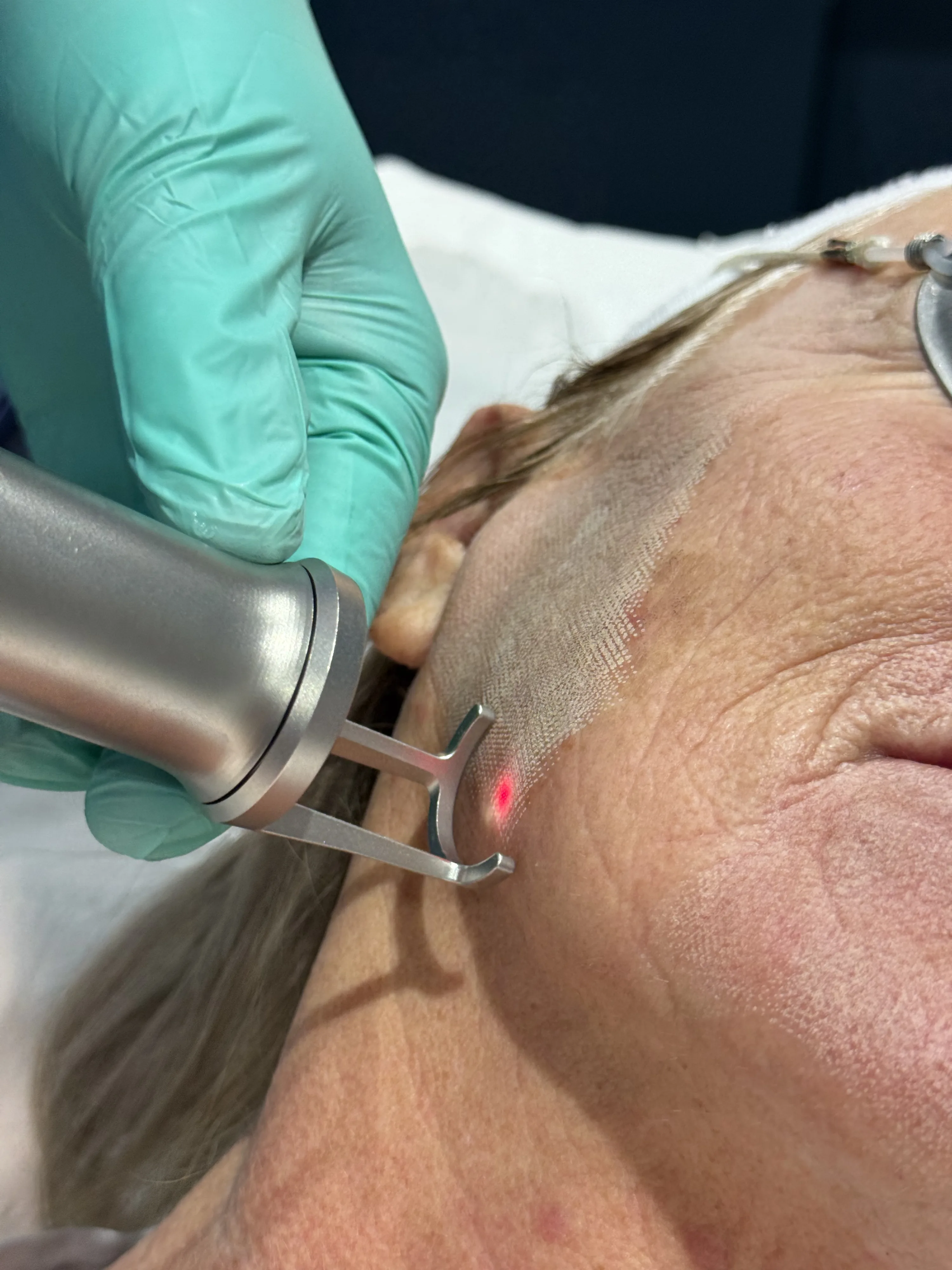 Doctor-led skin analysis for uneven skin tone, texture and dullness at Rejuvena Clinic, Bedford