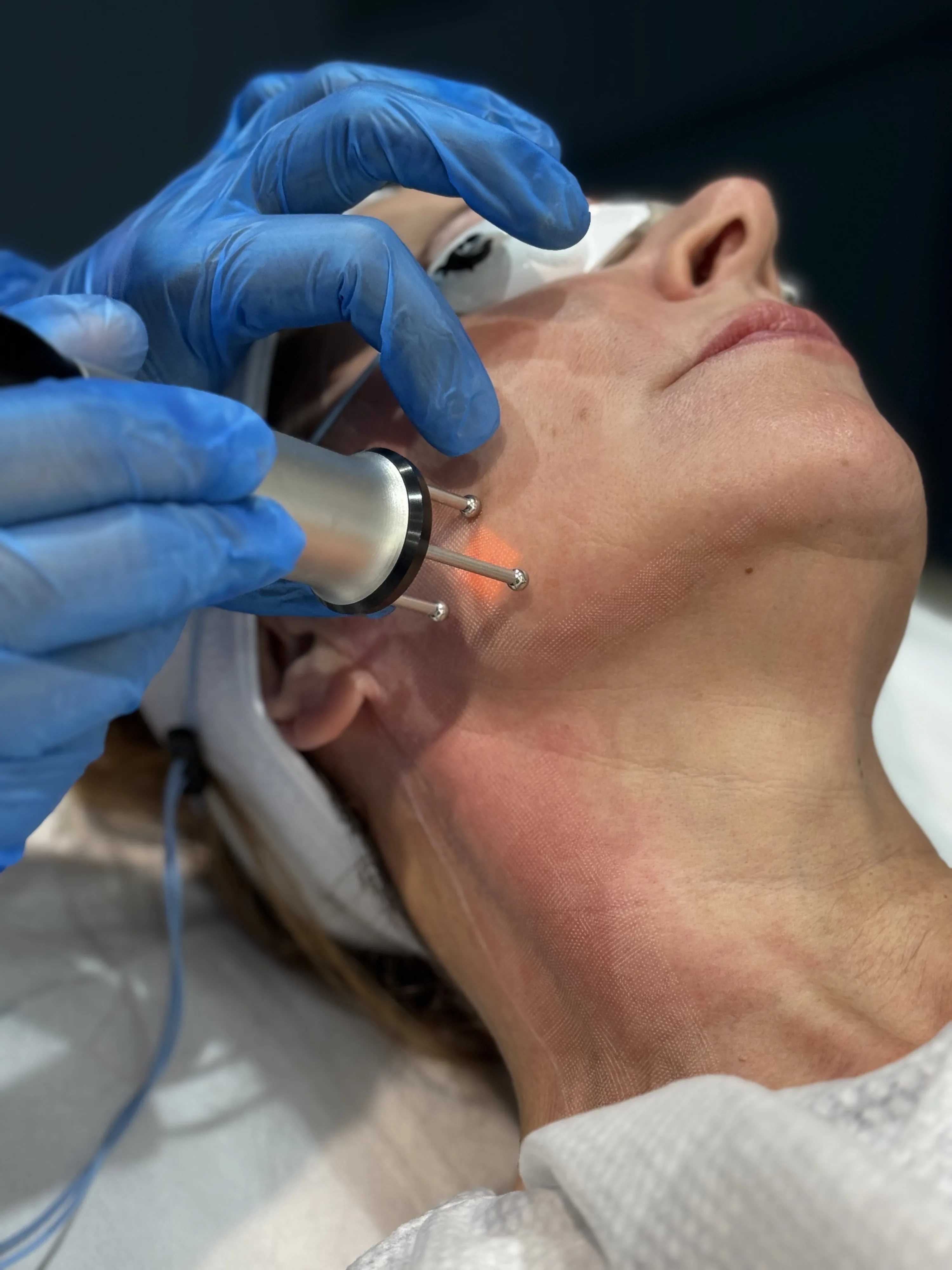 Clinician performing RF micro-needling stretch mark treatment at doctor-led Rejuvena Clinic, Bedford