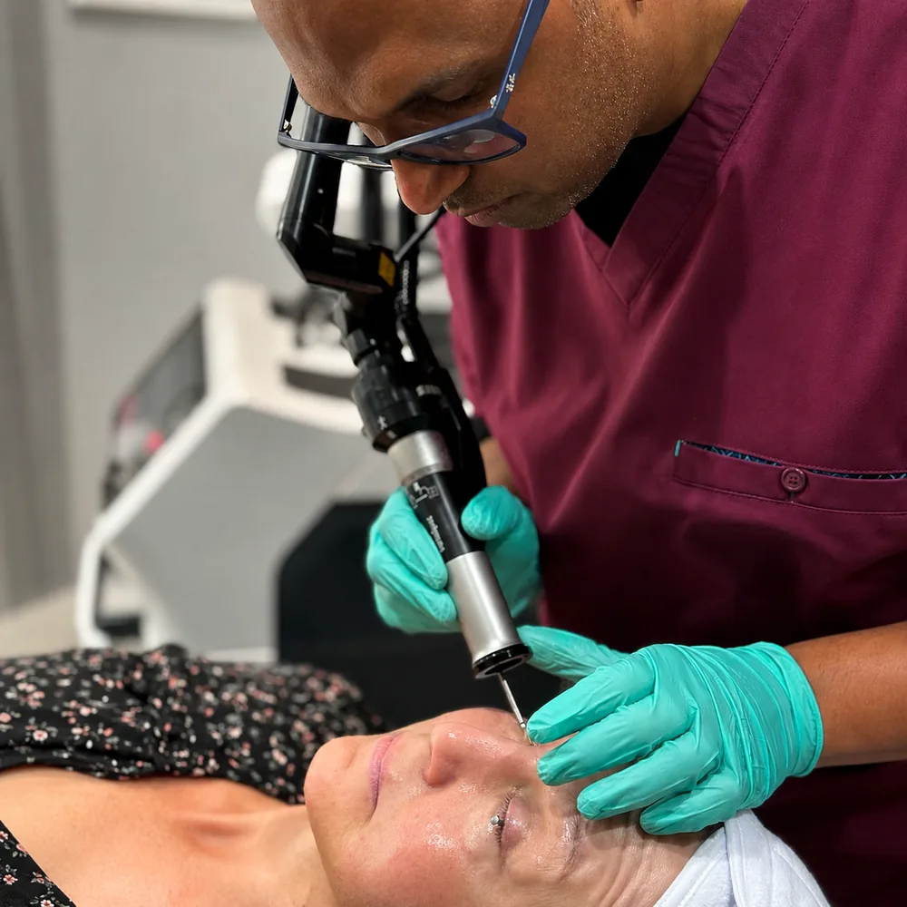 Dr Nick carrying out a Cool Bleph eyelid laser resurfacing treatment at Rejuvena Clinic in Bedford