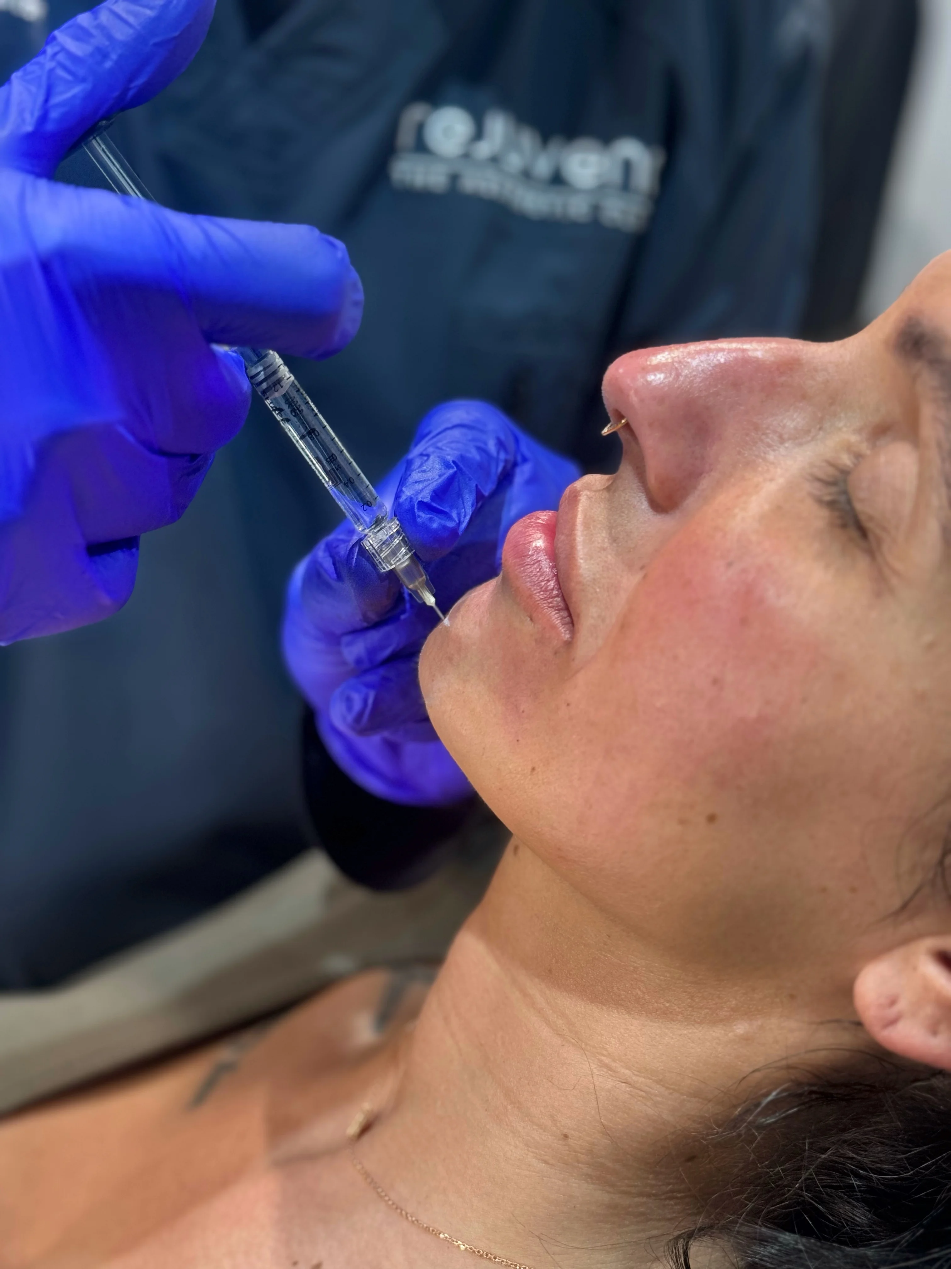 Doctor-led precision filler injection technique at Rejuvena Clinic in Bedford — the same doctor-administered approach used for Radiesse