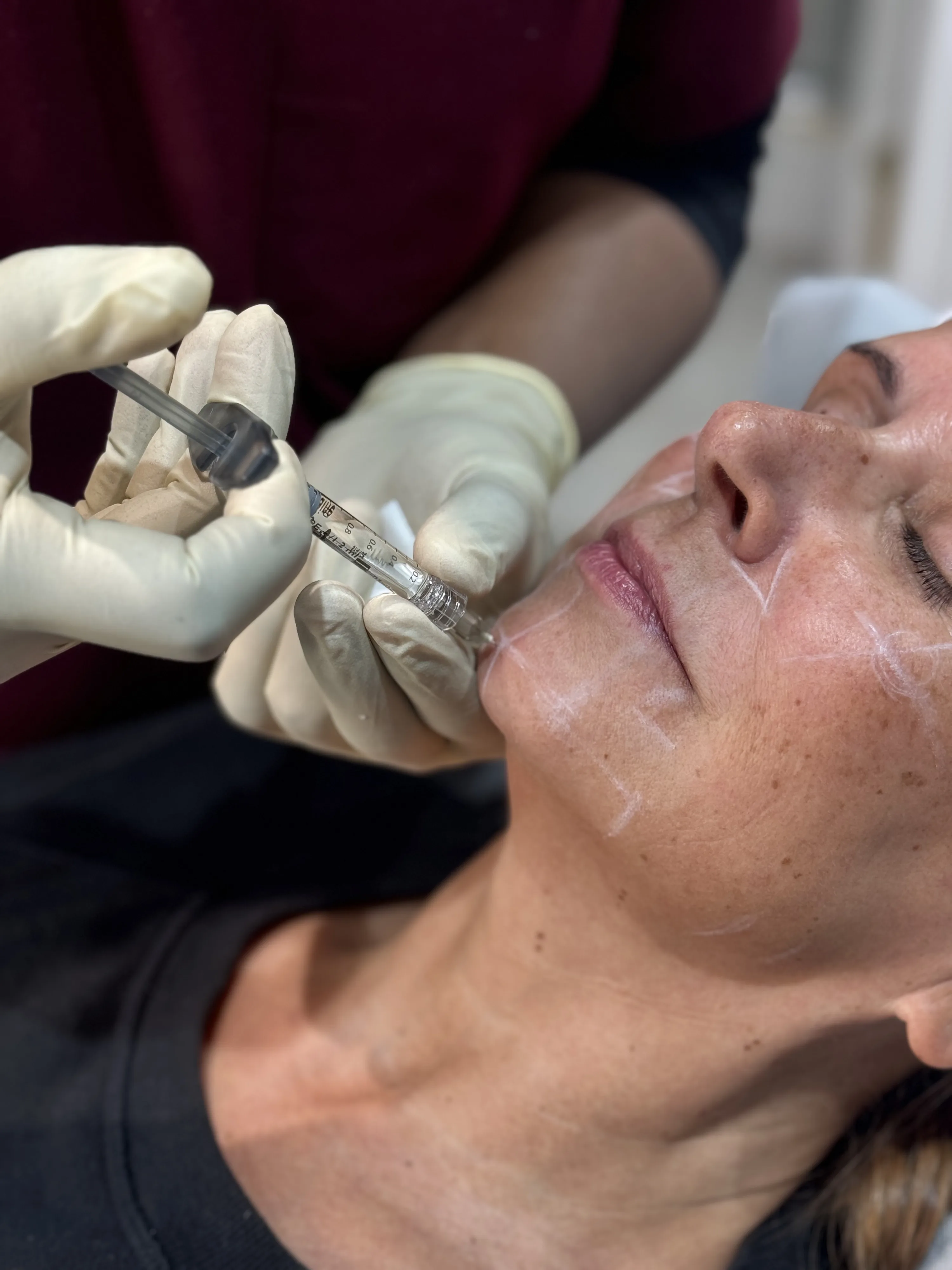 Doctor-led under-eye treatment being performed on a patient's face at Rejuvena Clinic, Bedford