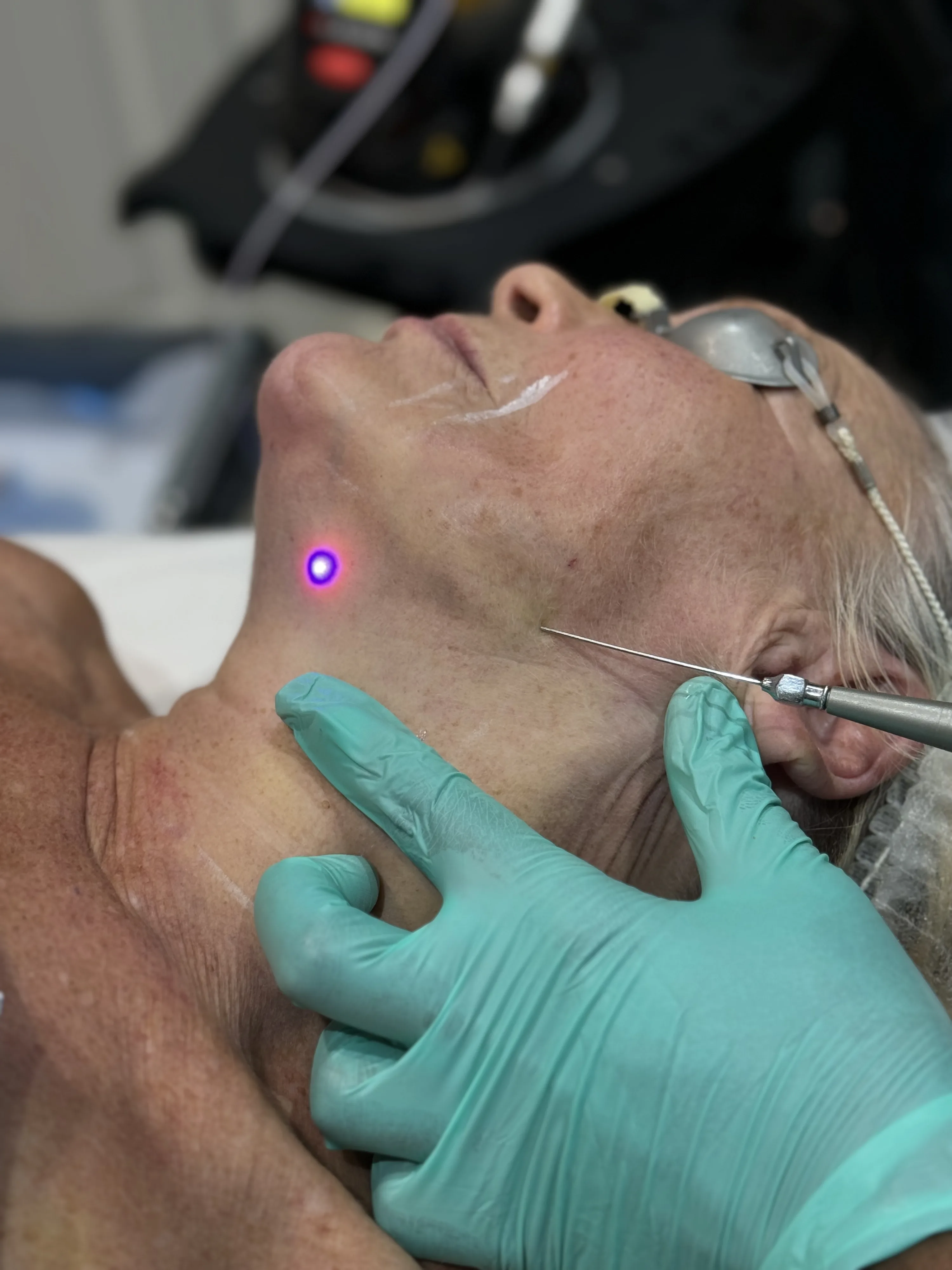 Dr Nick assessing a patient for non-surgical EndoContour radiofrequency skin tightening at Rejuvena Clinic in Bedford