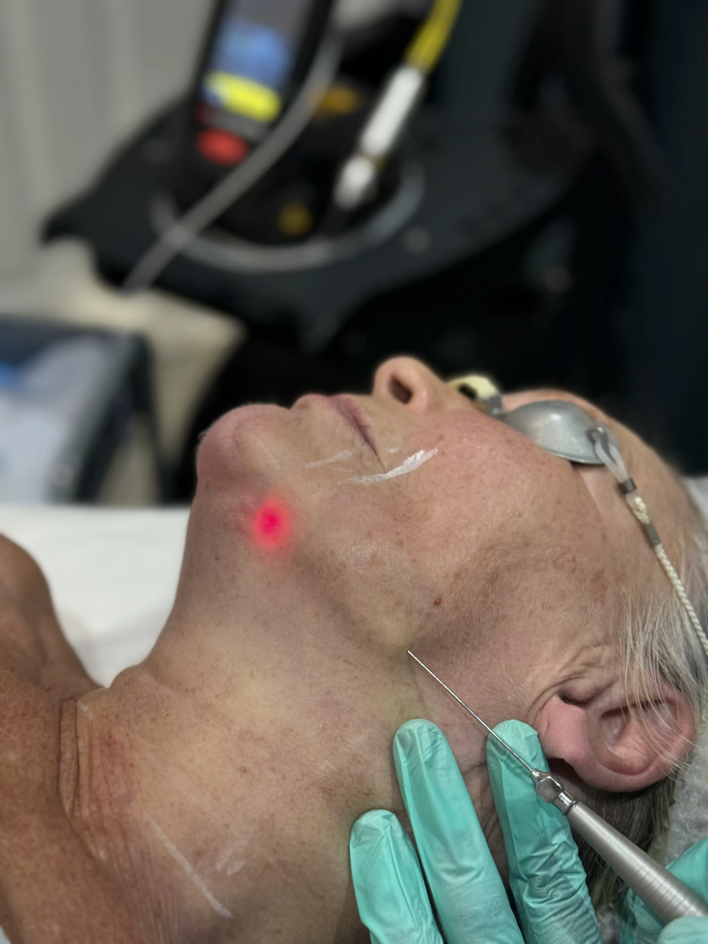 Clinician performing radiofrequency skin tightening on a patient's lower abdomen during doctor-led mummy tummy treatment at Rejuvena Clinic, Bedford