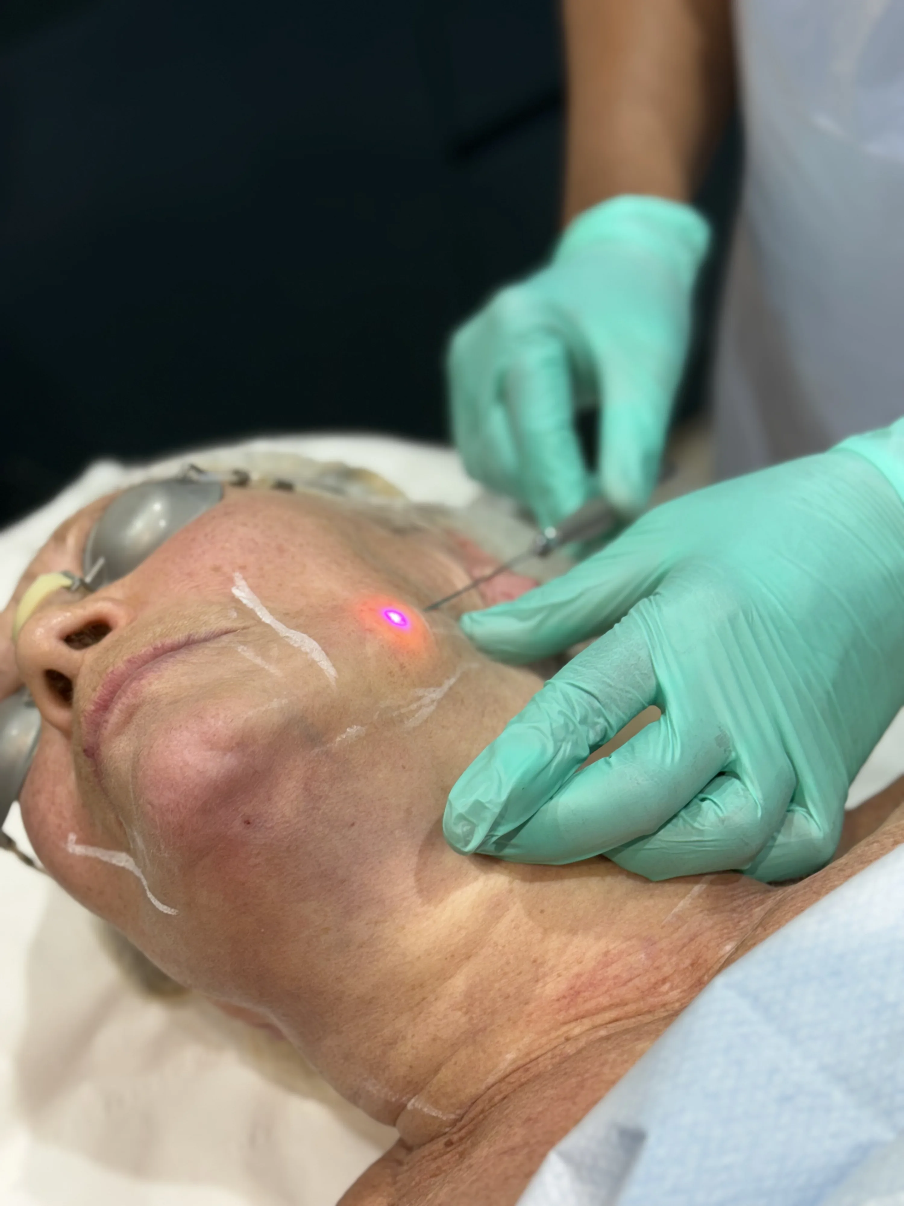 Skin therapist performing non-surgical radiofrequency body contouring on a patient's thigh during doctor-led cellulite care at Rejuvena Clinic, Bedford