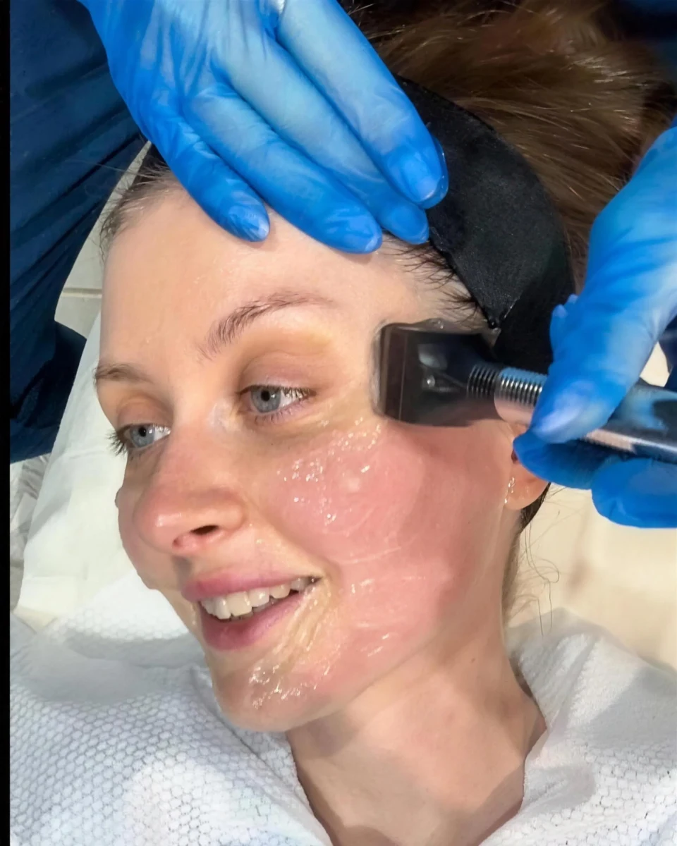 Patient receiving Forma RF skin-tightening treatment at Rejuvena Clinic, Bedford