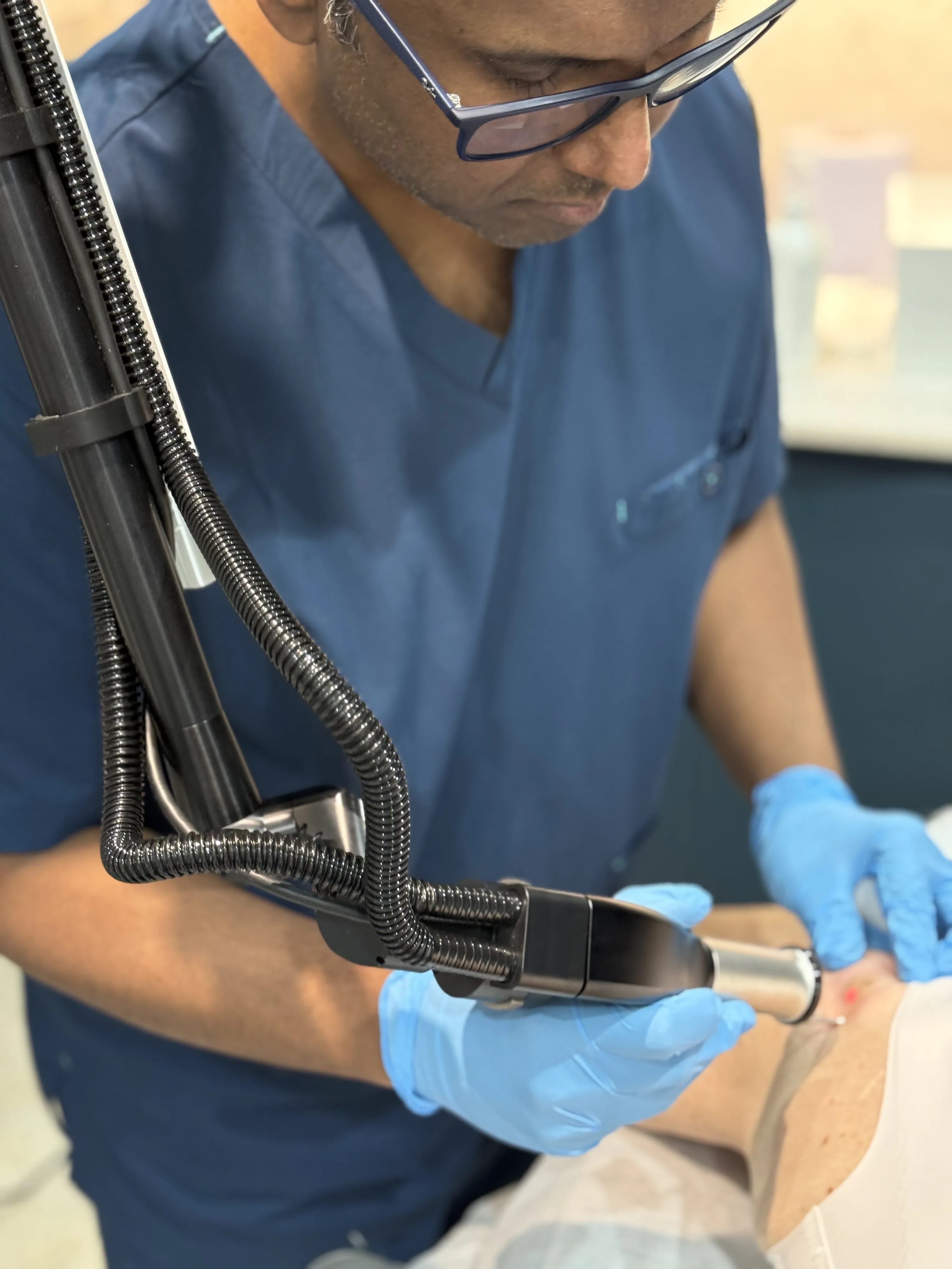 Doctor-led laser lesion and mole removal using a precision laser handpiece at Rejuvena Clinic, Bedford