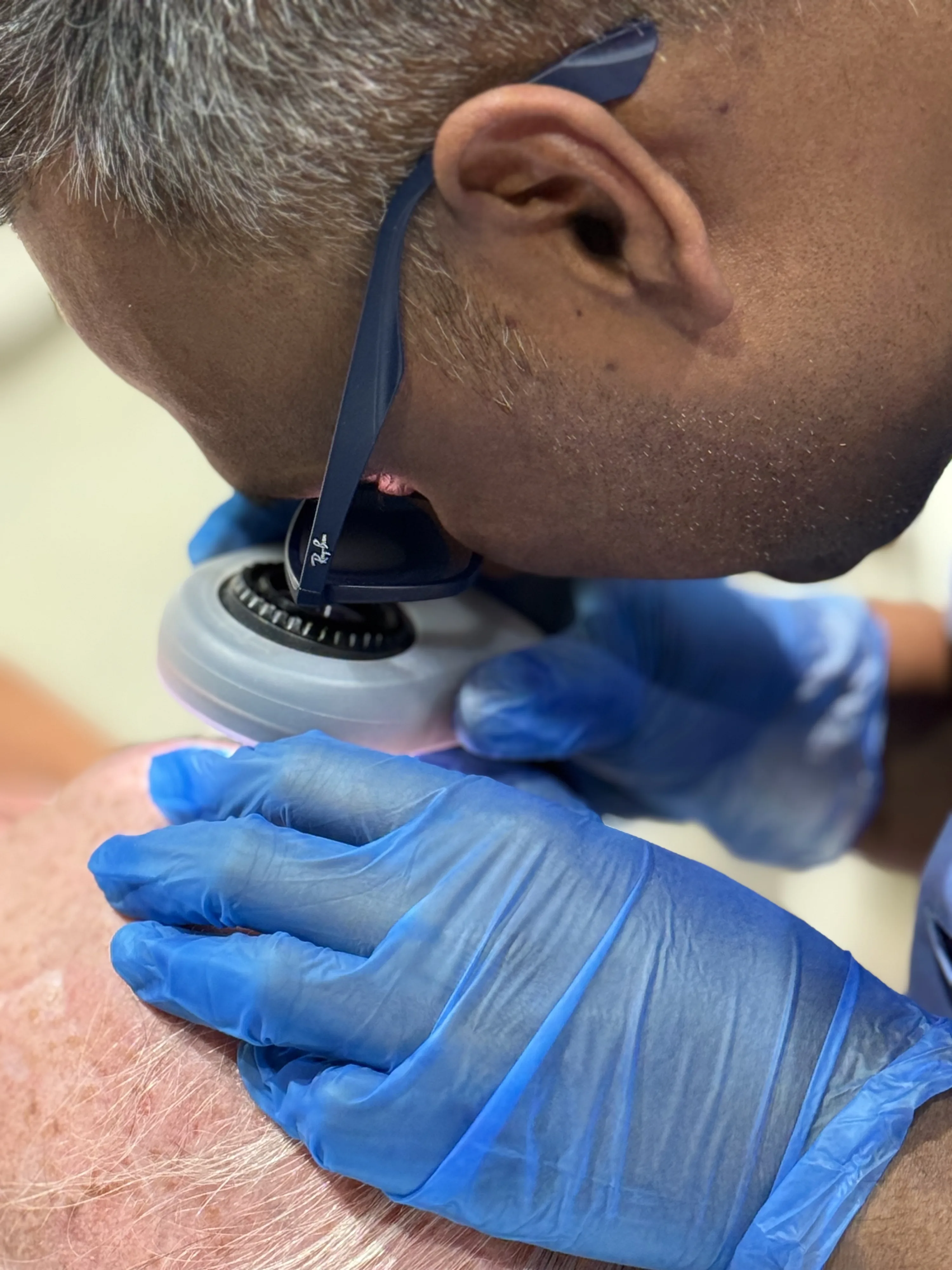 Doctor-led cherry angioma assessment and removal at Rejuvena Clinic, Bedford