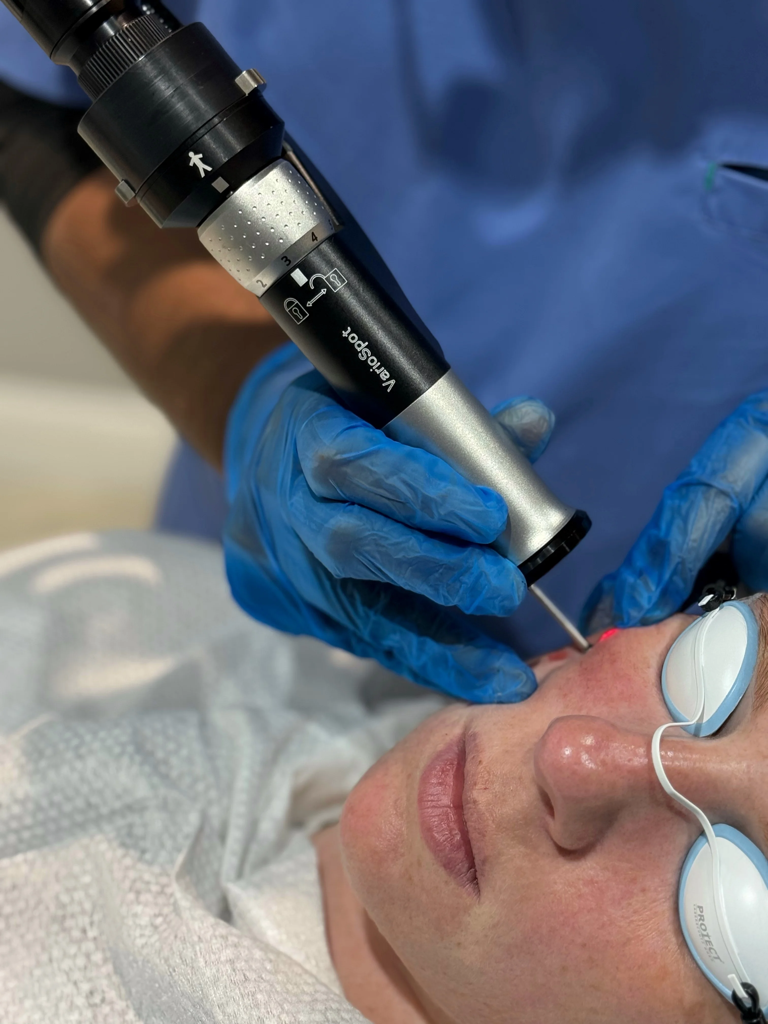 Clinician aiming a laser handpiece at the skin during doctor-led verruca removal at Rejuvena Clinic, Bedford