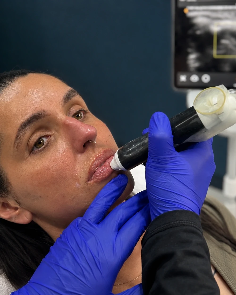 Ultrasound scan of the lip and peri-oral area before filler treatment at Rejuvena Clinic, Bedford