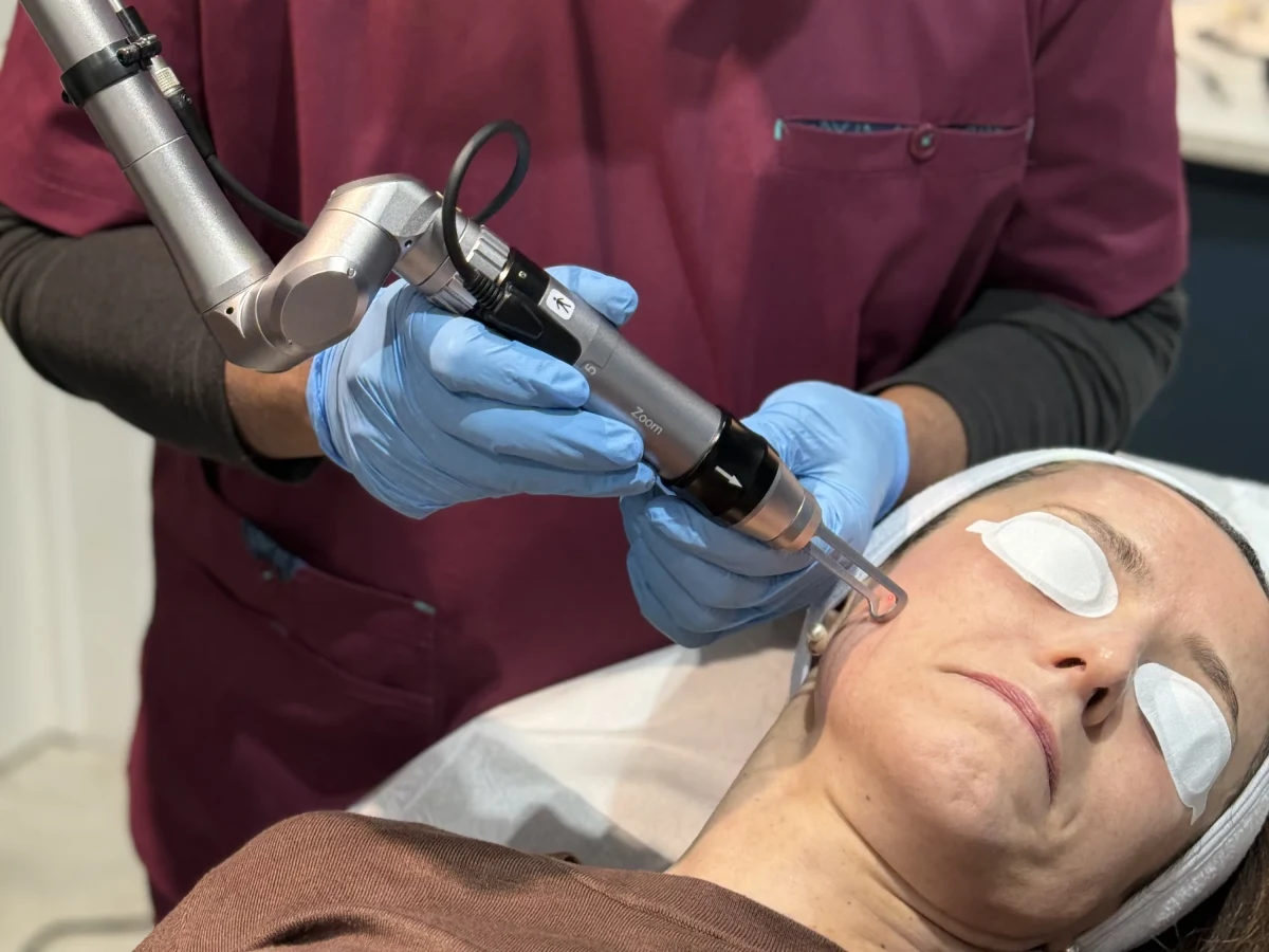 Picosecond laser handpiece delivering pico toning close to a patient's cheek, protective eyewear fitted, at Rejuvena Clinic in Bedford