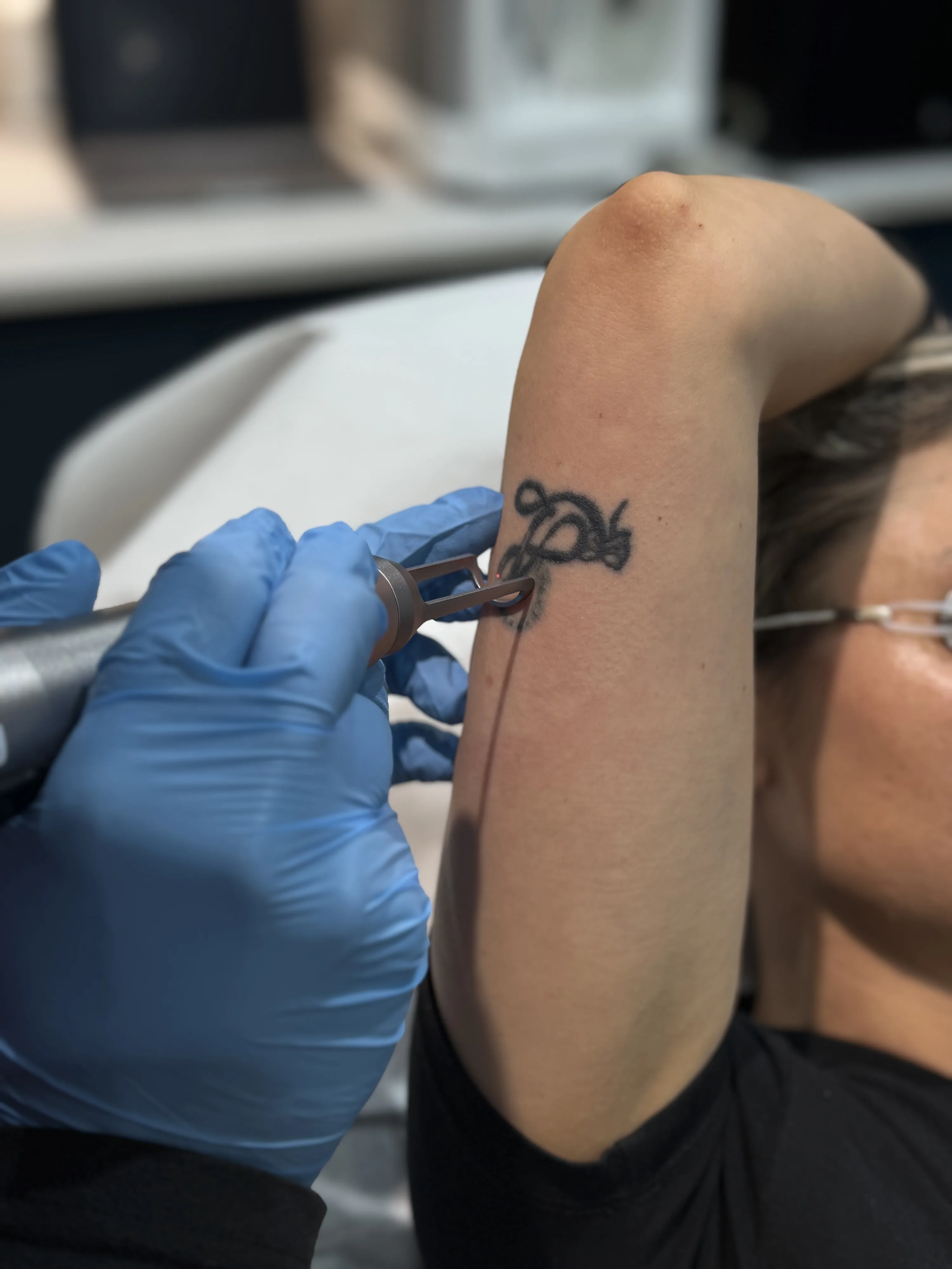 Laser tattoo removal session in progress at Rejuvena Bedford