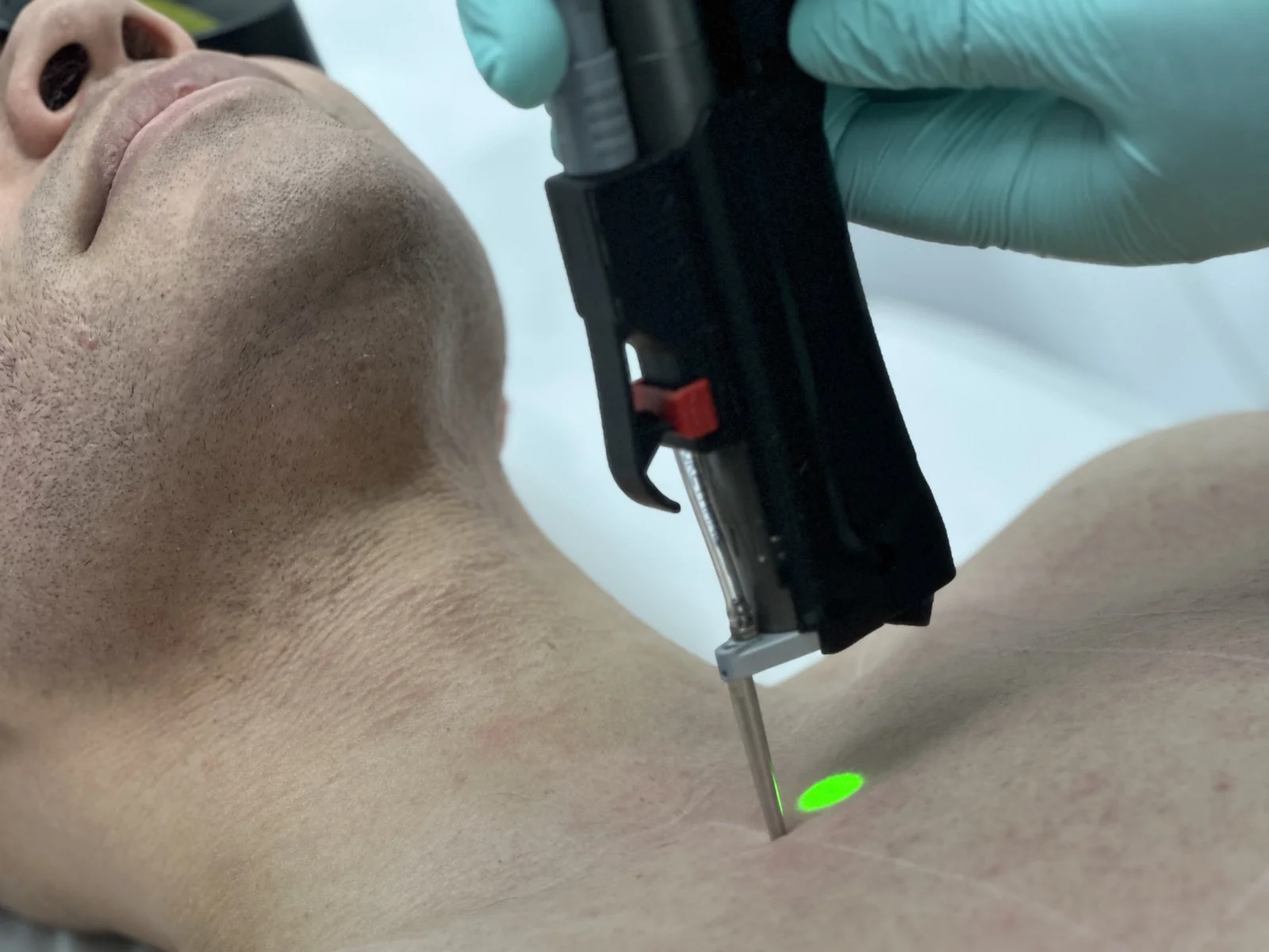 Laser hair removal on a patient's chest with the aiming beam visible — Rejuvena Clinic, Bedford