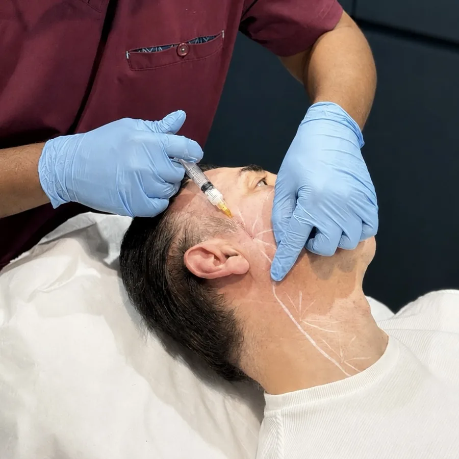 Dr Nick injecting Radiesse along a pre-marked jawline at Rejuvena Clinic in Bedford