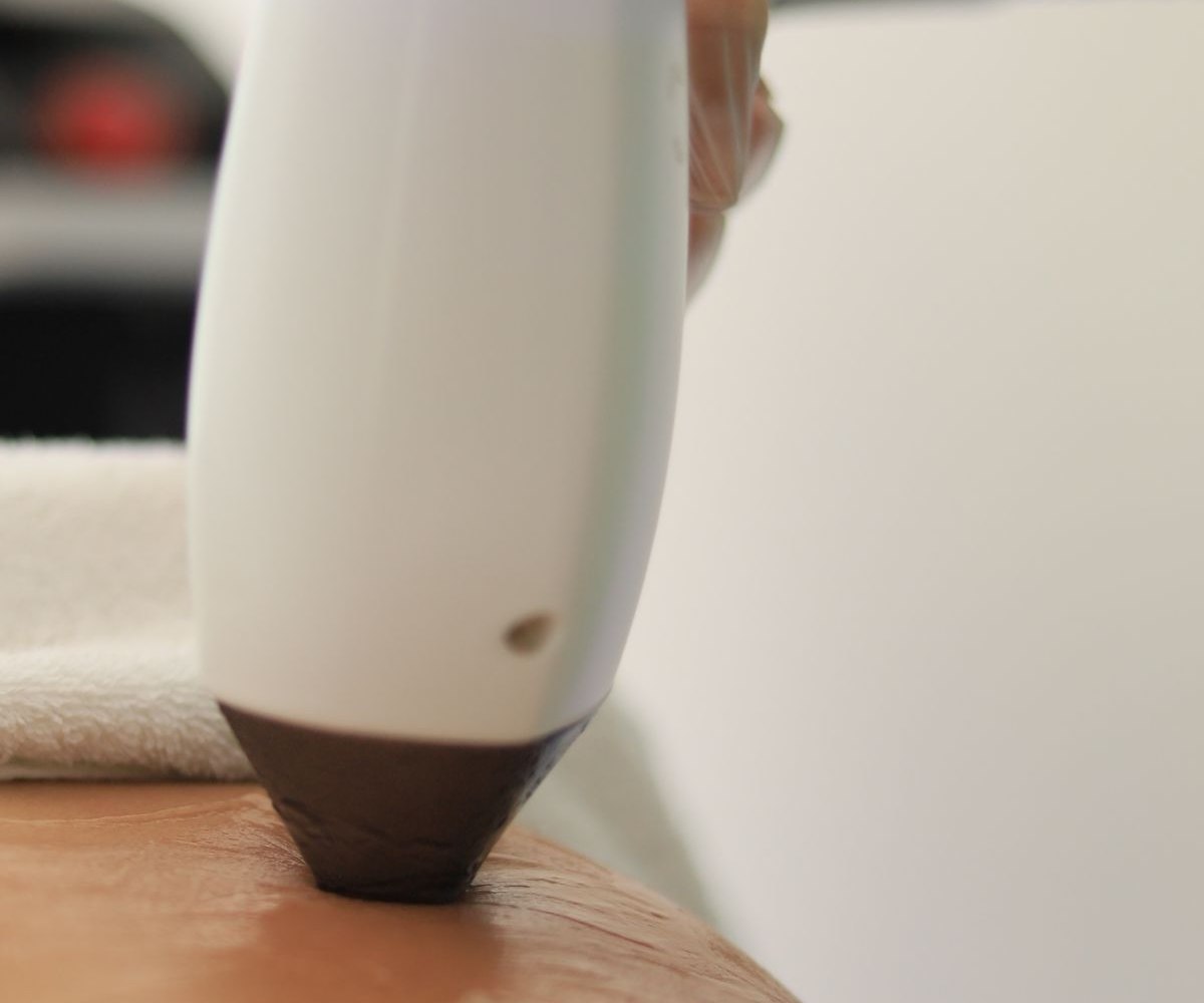 Laser handpiece resurfacing pigmented skin, used for stubborn sun spots at Rejuvena Bedford