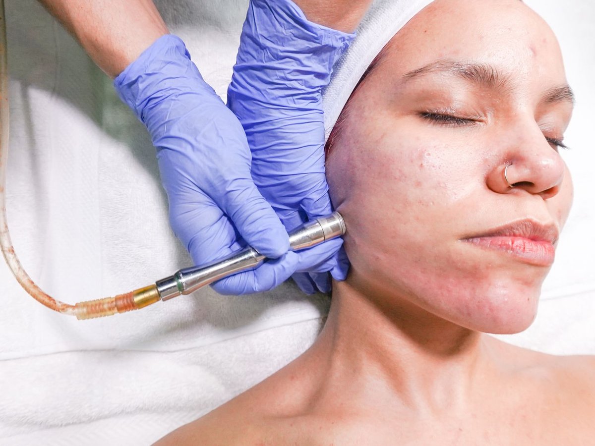 Skin resurfacing device handpiece treating cheek texture during doctor-led care for dullness and uneven texture, Rejuvena Bedford