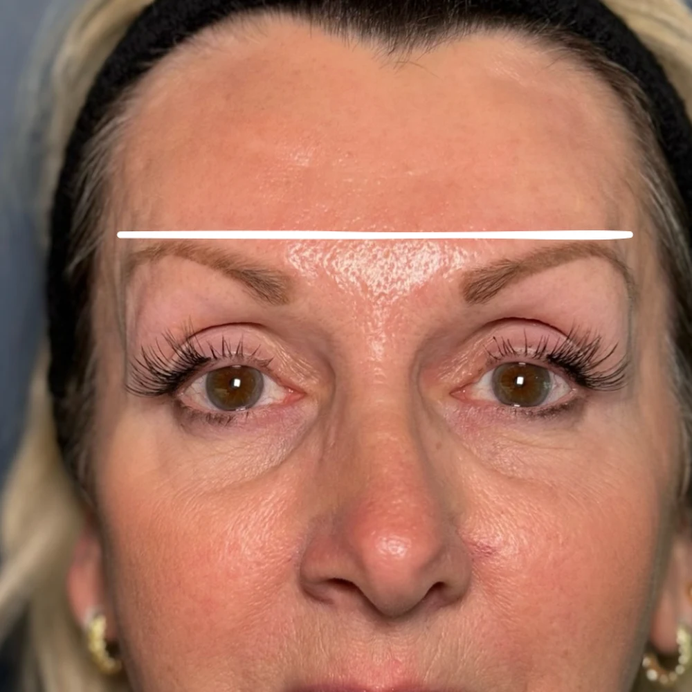 After anti-wrinkle injections: brow and upper eyes at Rejuvena, Bedford