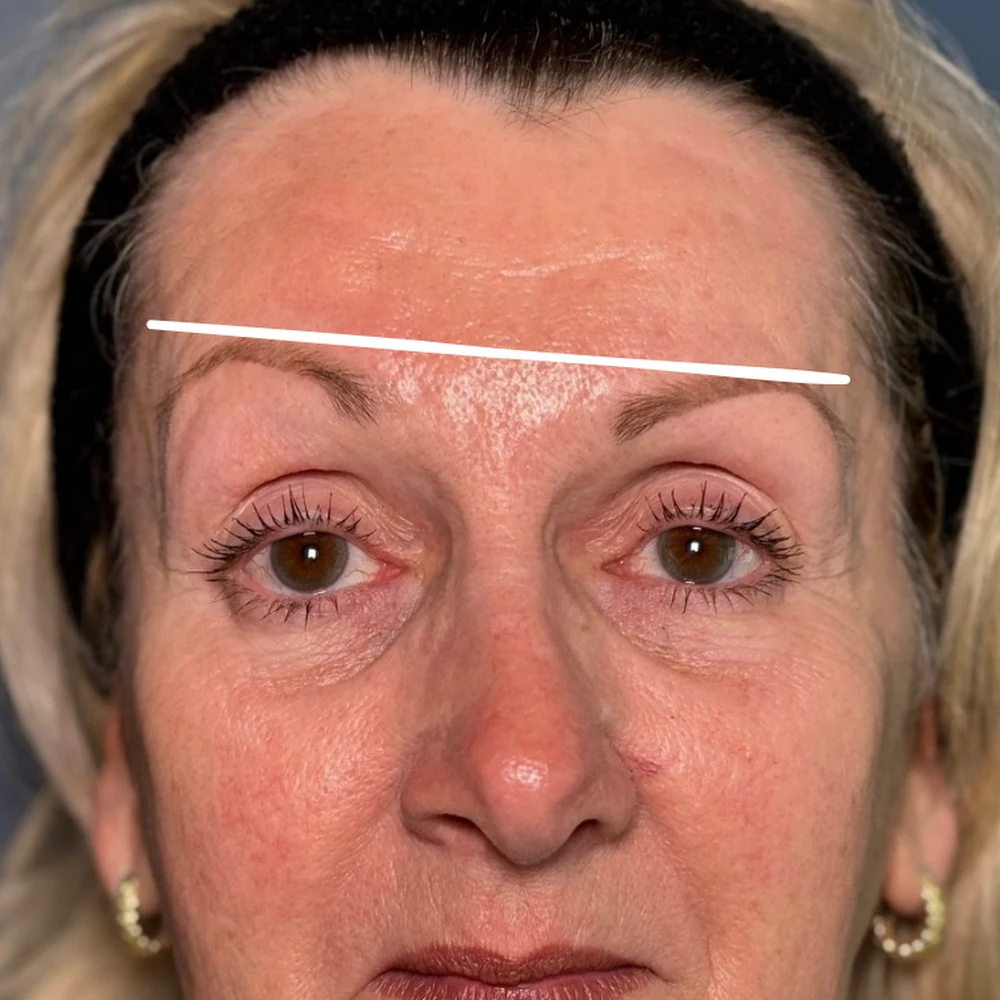 Before anti-wrinkle injections: brow and upper eyes at Rejuvena, Bedford