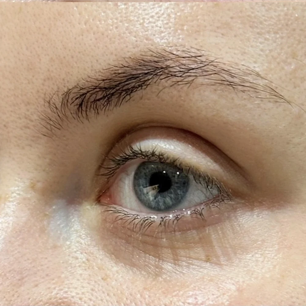 After anti-wrinkle injections: crow's feet at Rejuvena, Bedford