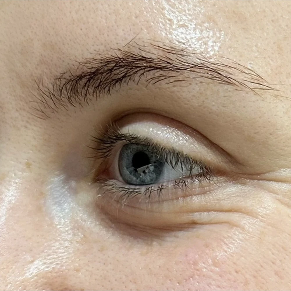 Before anti-wrinkle injections: crow's feet at Rejuvena, Bedford