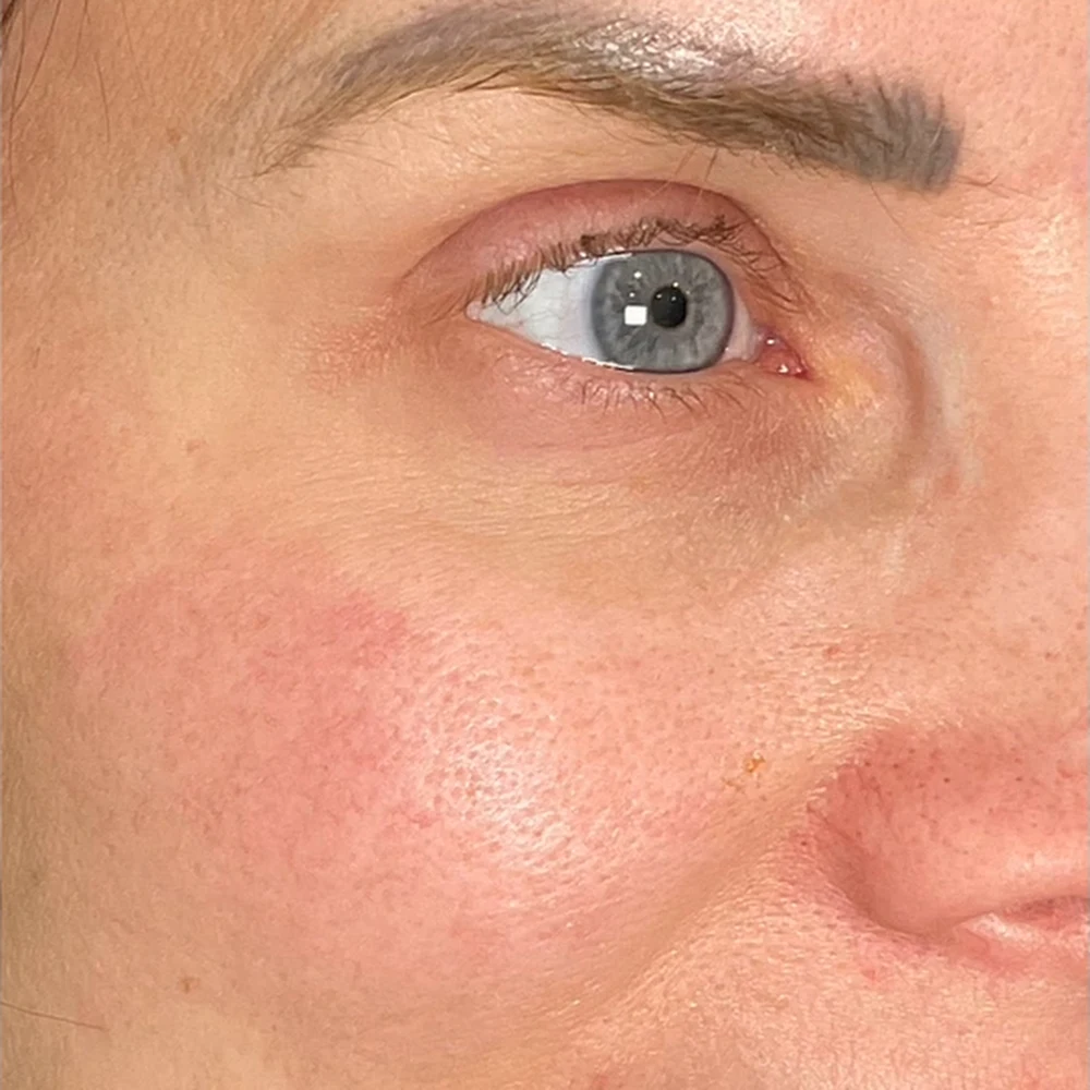 After anti-wrinkle injections: eye area and fine lines at Rejuvena, Bedford