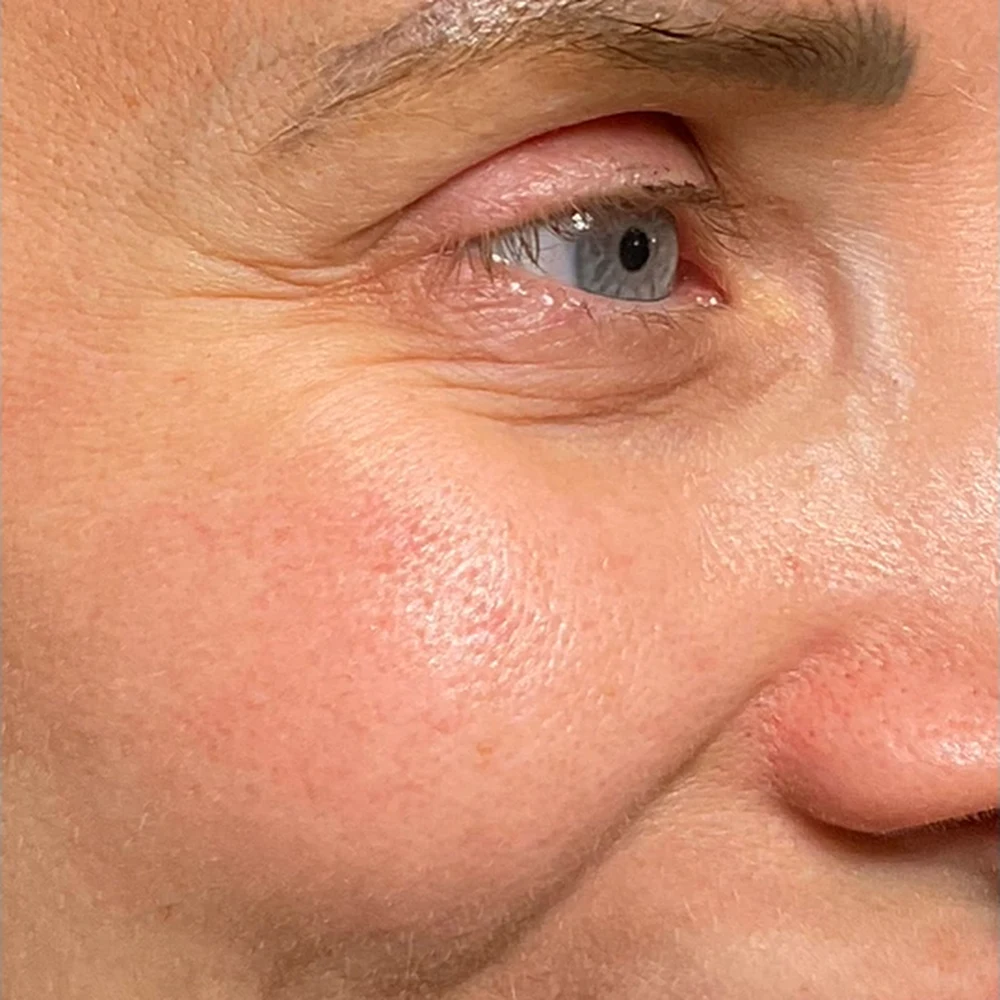 Before anti-wrinkle injections: eye area and fine lines at Rejuvena, Bedford
