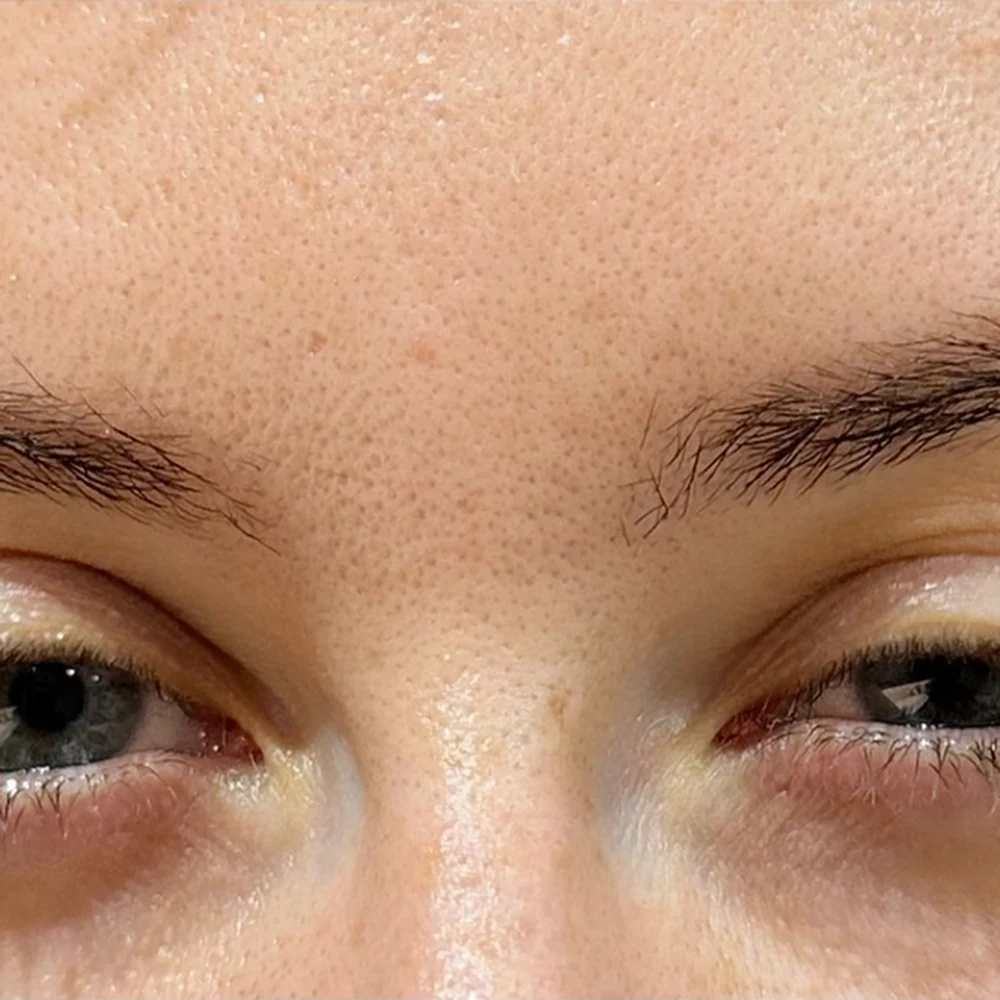 After anti-wrinkle injections: frown lines (the 11s) at Rejuvena, Bedford