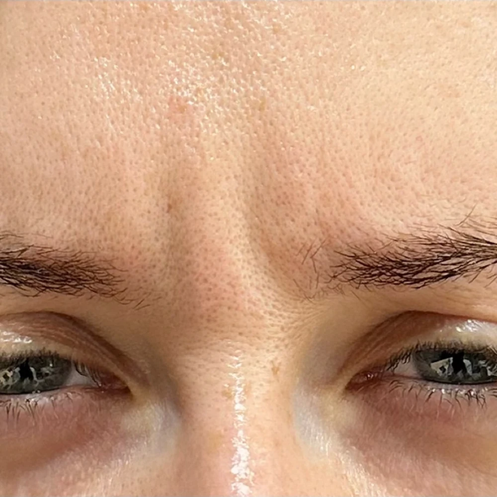 Before anti-wrinkle injections: frown lines (the 11s) at Rejuvena, Bedford