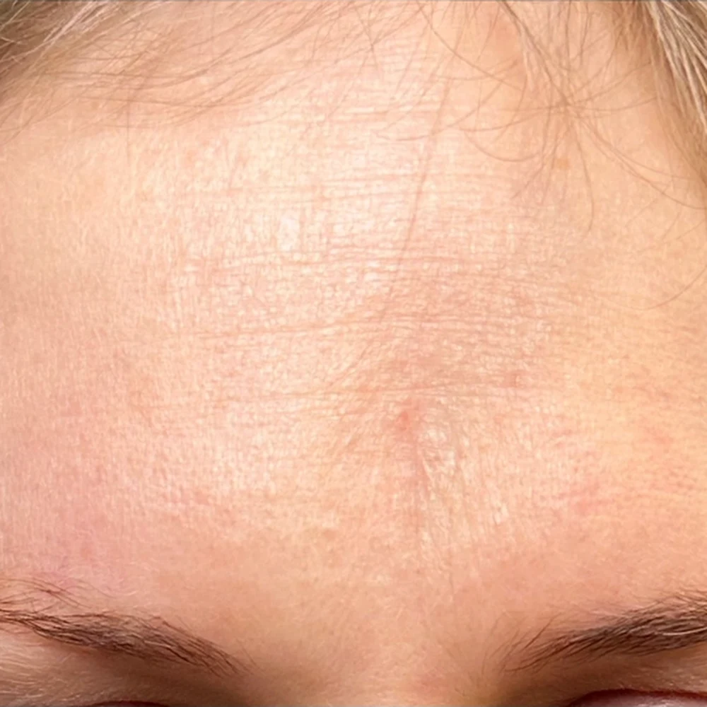 After anti-wrinkle injections: forehead lines at Rejuvena, Bedford