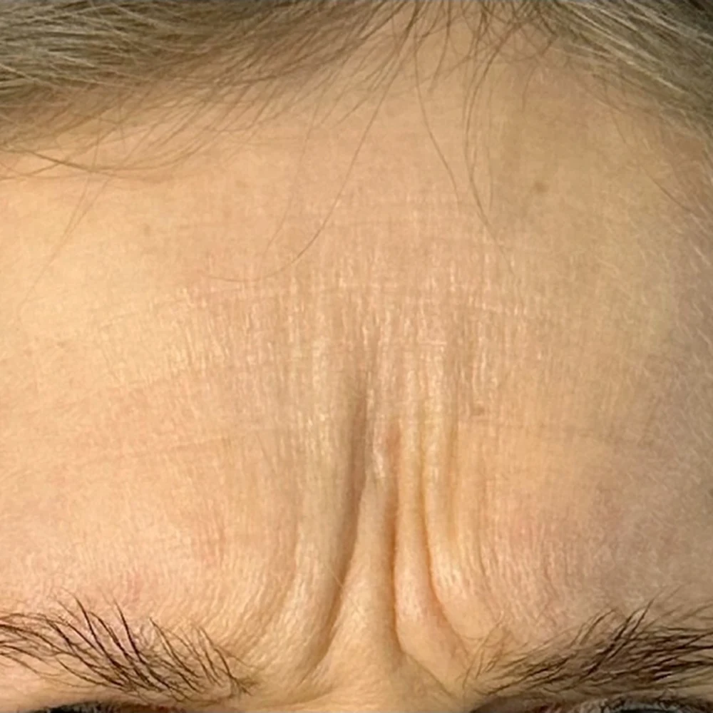 Before anti-wrinkle injections: forehead lines at Rejuvena, Bedford