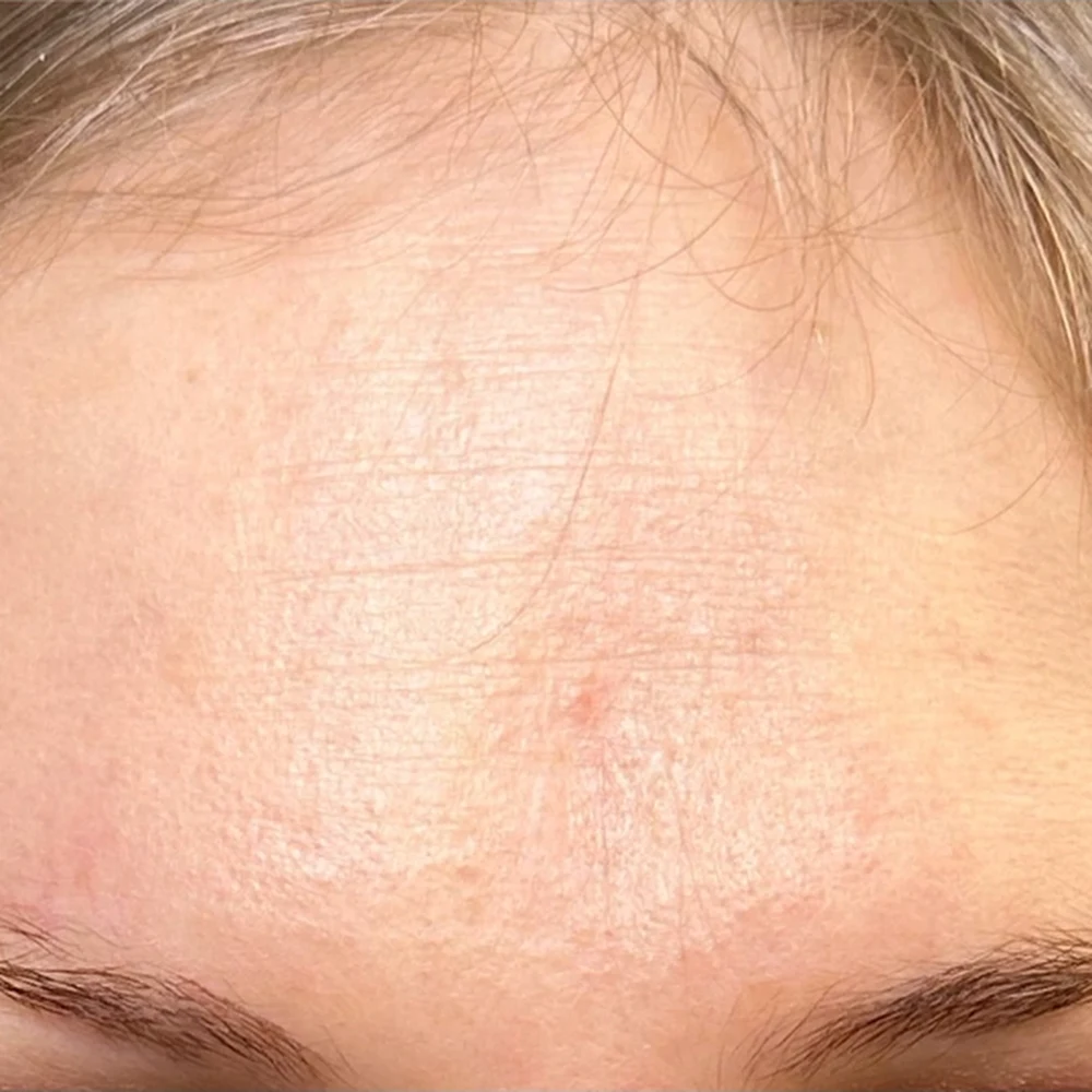 After anti-wrinkle injections: forehead and brow lines at Rejuvena, Bedford