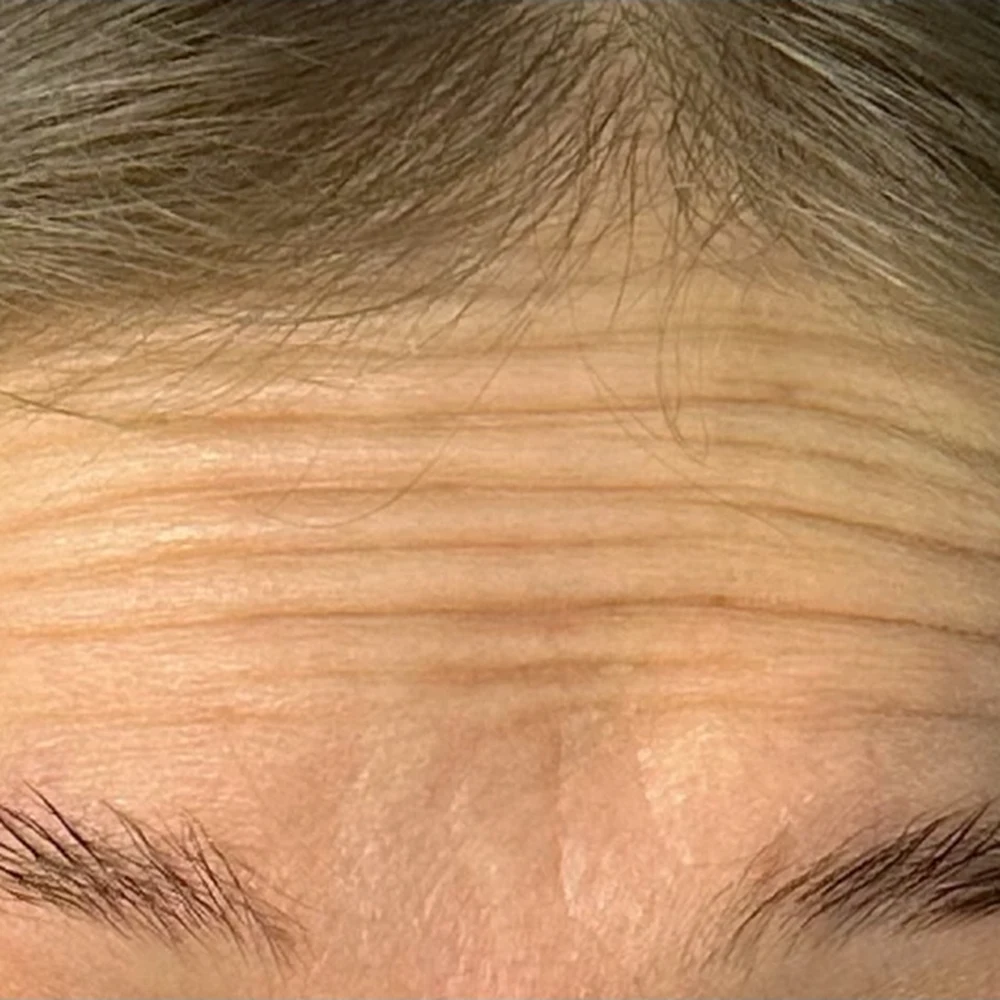 Before anti-wrinkle injections: forehead and brow lines at Rejuvena, Bedford