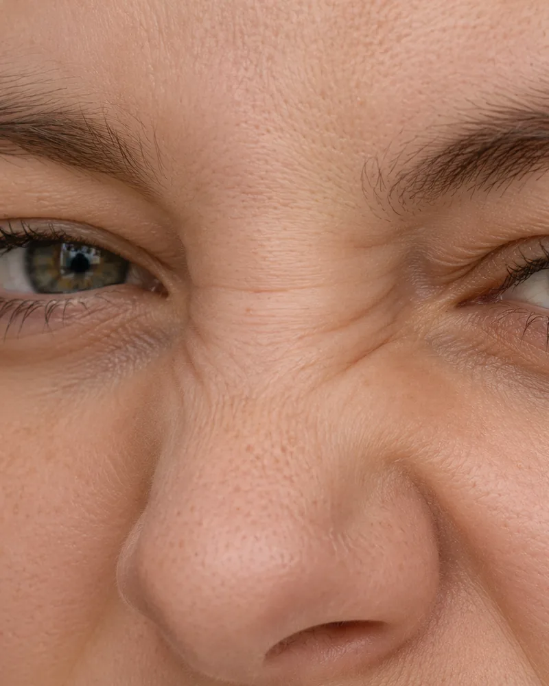 Natural image showing bunny lines (nose)