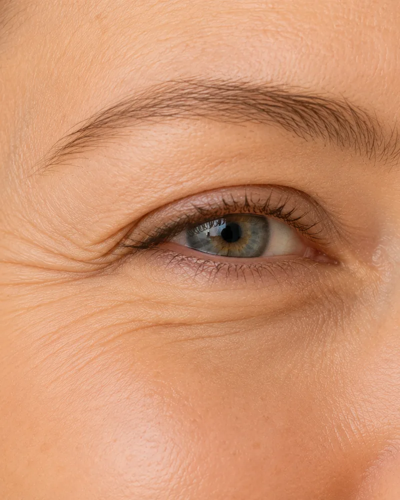 Natural image showing crow's feet