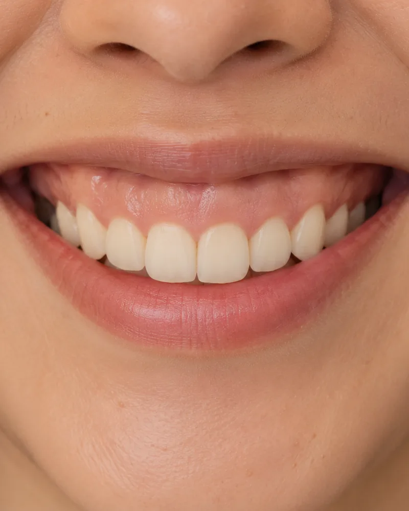 Natural smile and upper lip for gummy smile correction and lip flip, Bedford